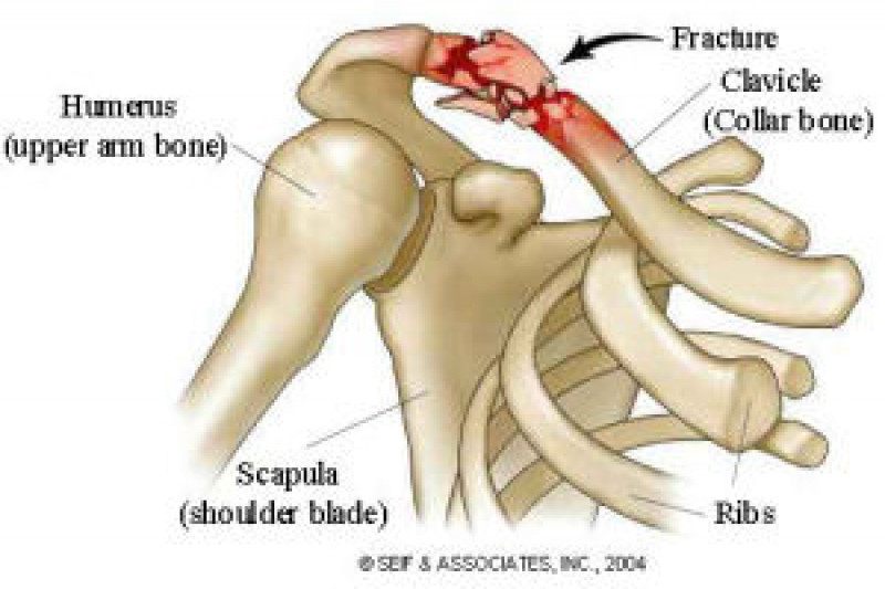 Symptoms of hip fracture in adults