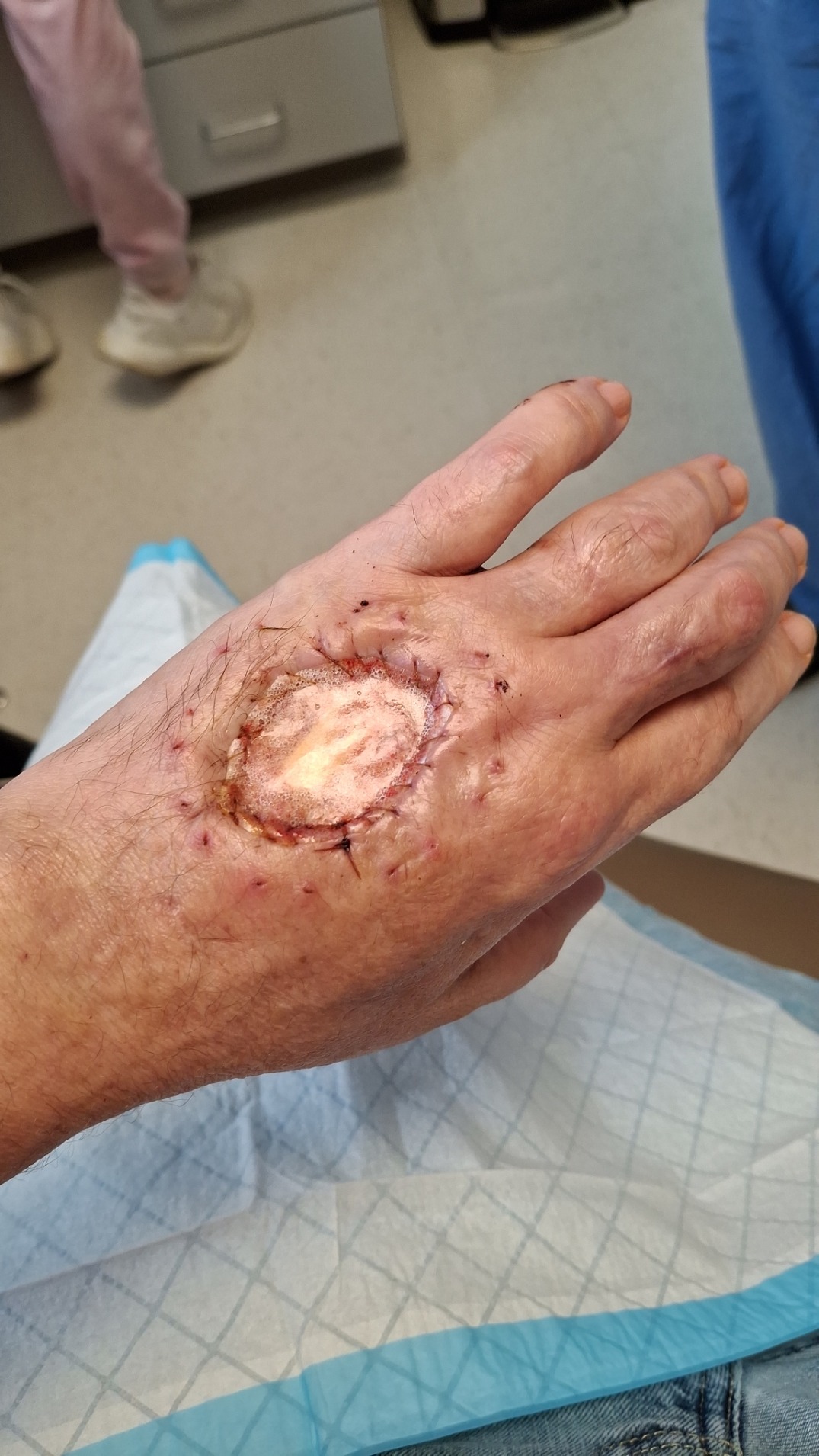 Support for Daniel's Recovery After Opossum Bite campaign photo, 2 of 8
