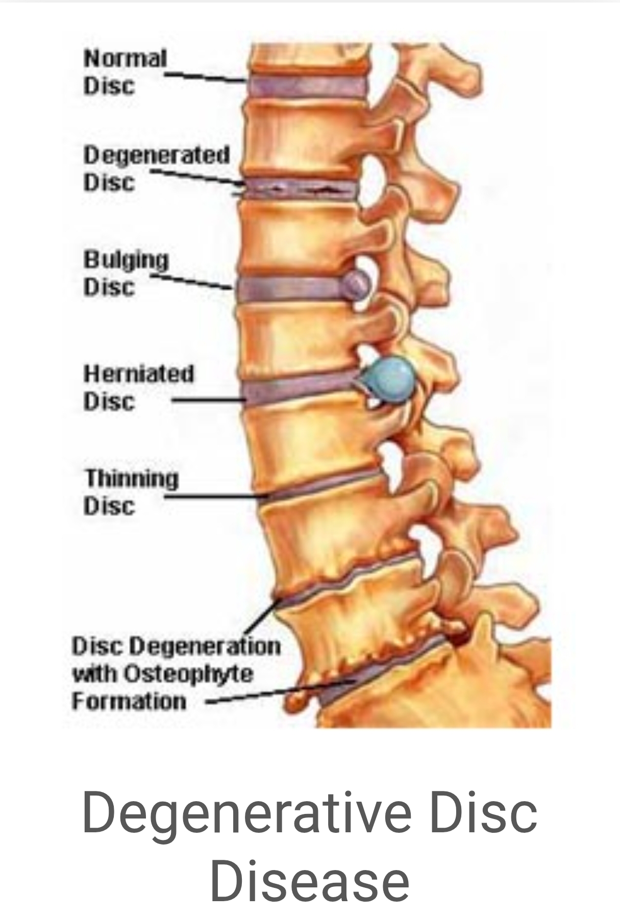 Support Mark’s Back Surgery & Recovery campaign photo, 2 of 4