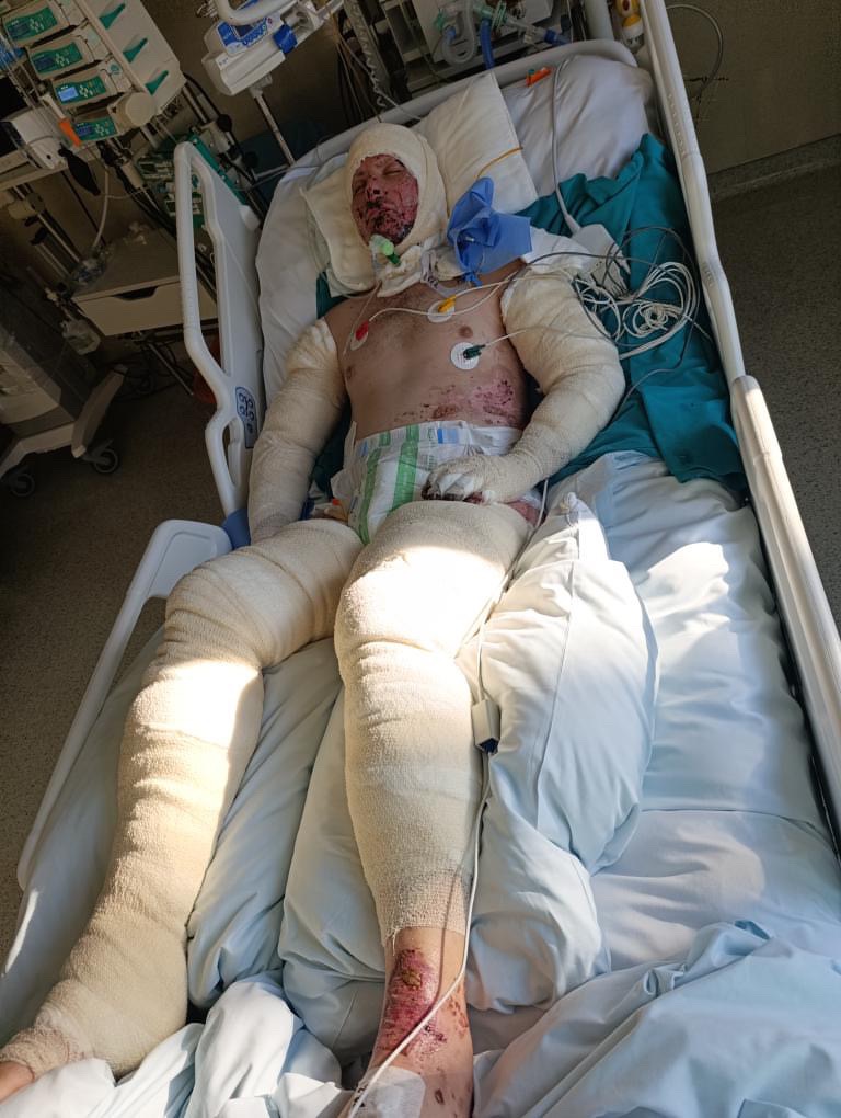 Help Predrag Recover from Devastating Burns campaign photo, 2 of 8
