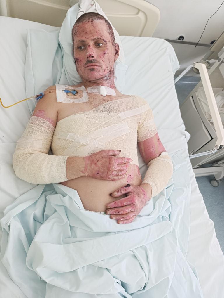 Help Predrag Recover from Devastating Burns campaign photo, 4 of 8