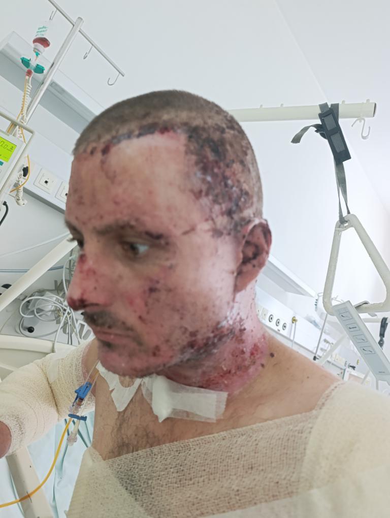Help Predrag Recover from Devastating Burns campaign photo, 6 of 8