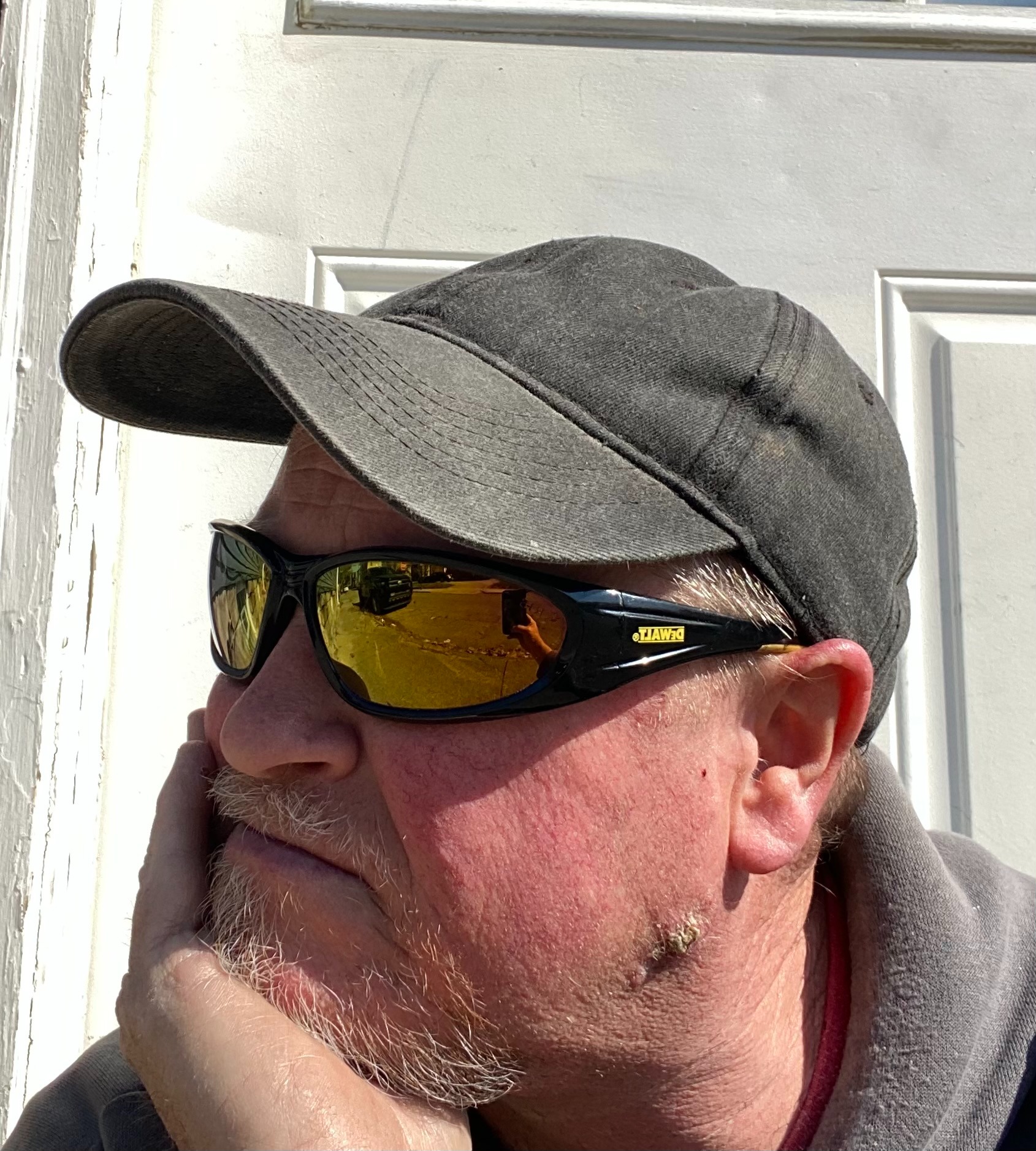 Support My Fight Against Basal Cell Carcinoma campaign photo, 4 of 6