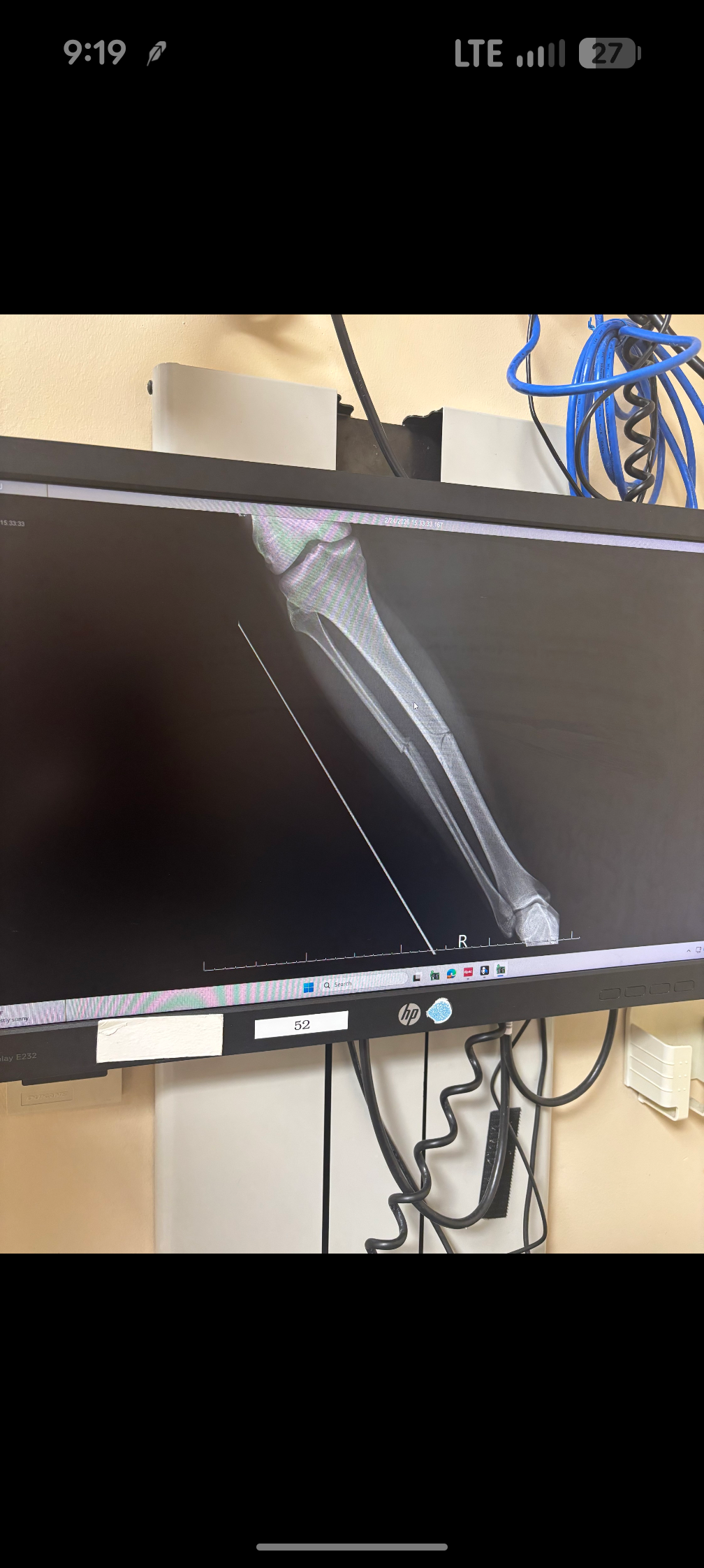 Roper Stone- Recovery after Injury  campaign photo, 4 of 6