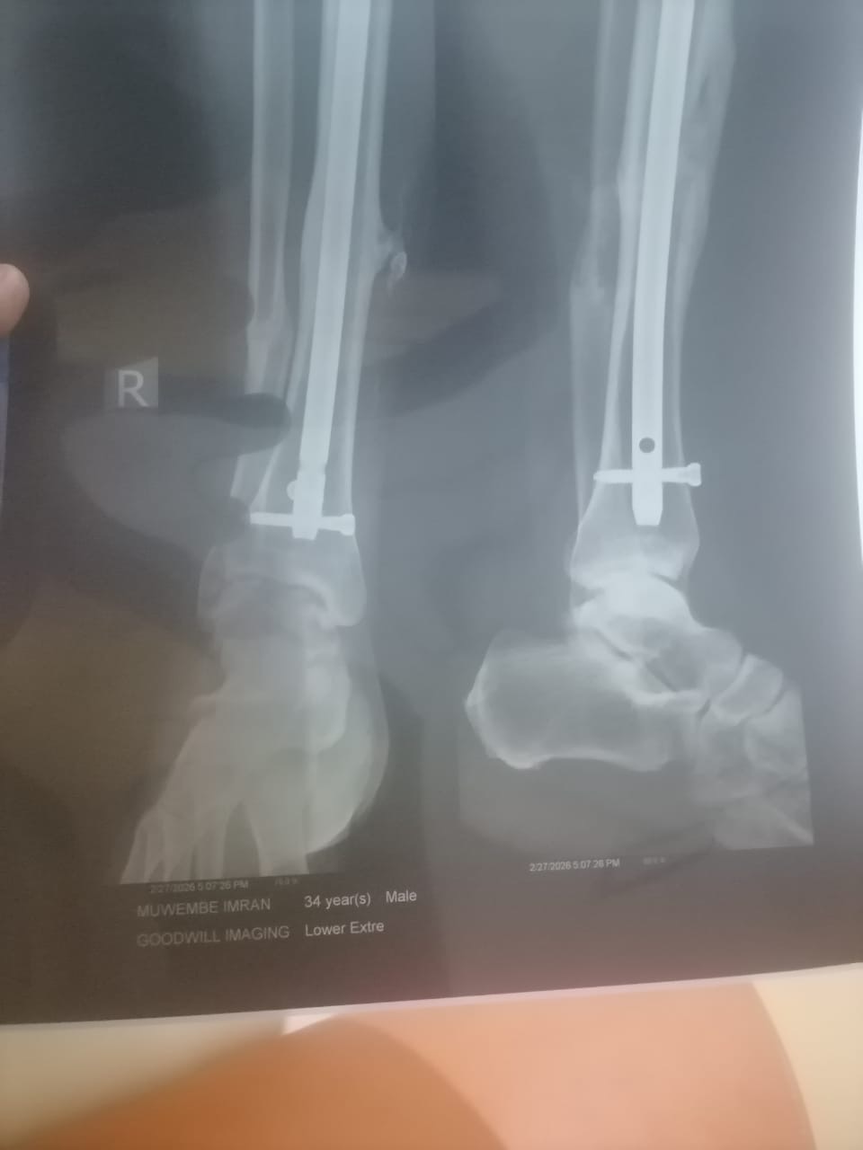 Urgent Surgery for Imran campaign photo, 2 of 8