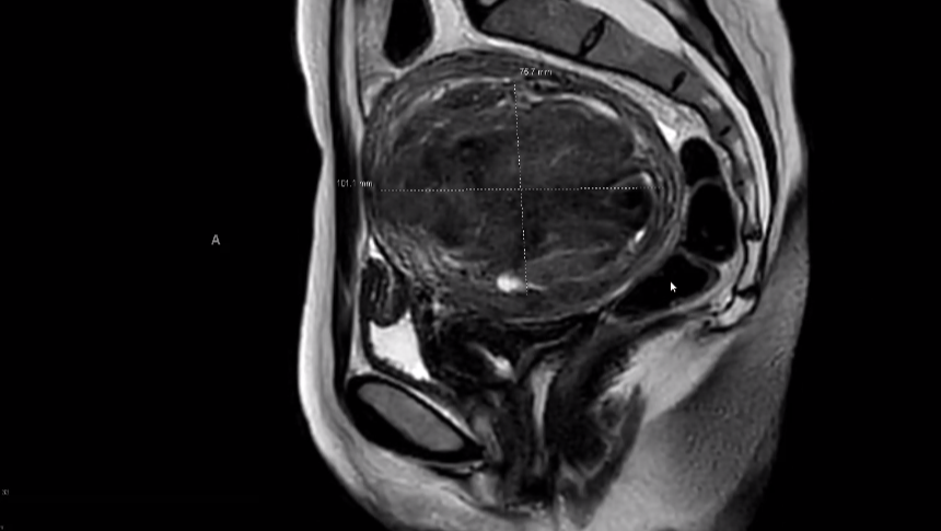 Support Kate's Healing after Abdominal Myomectomy