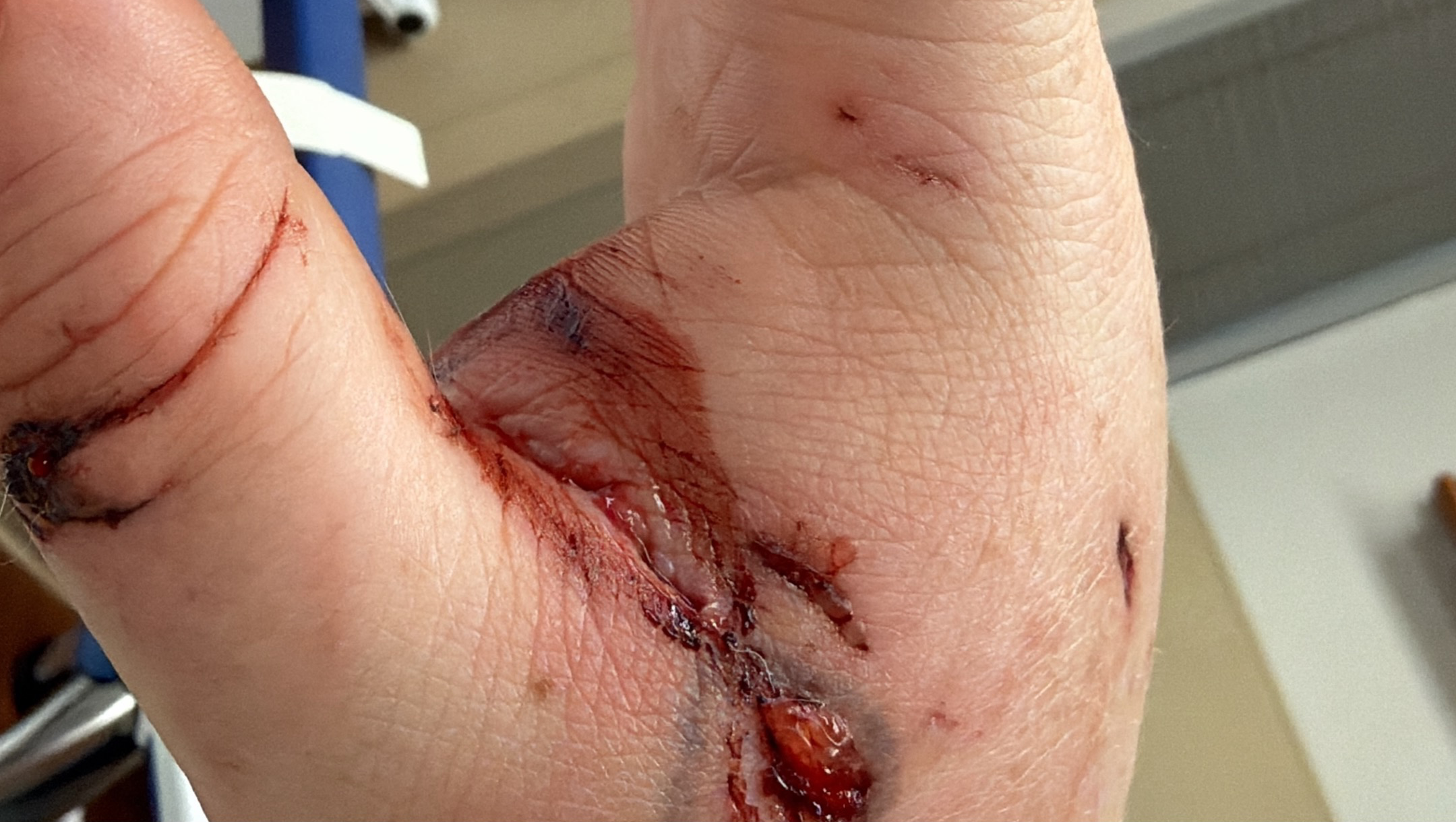 Help Leanne Rebuild Her Hand & Independence photo