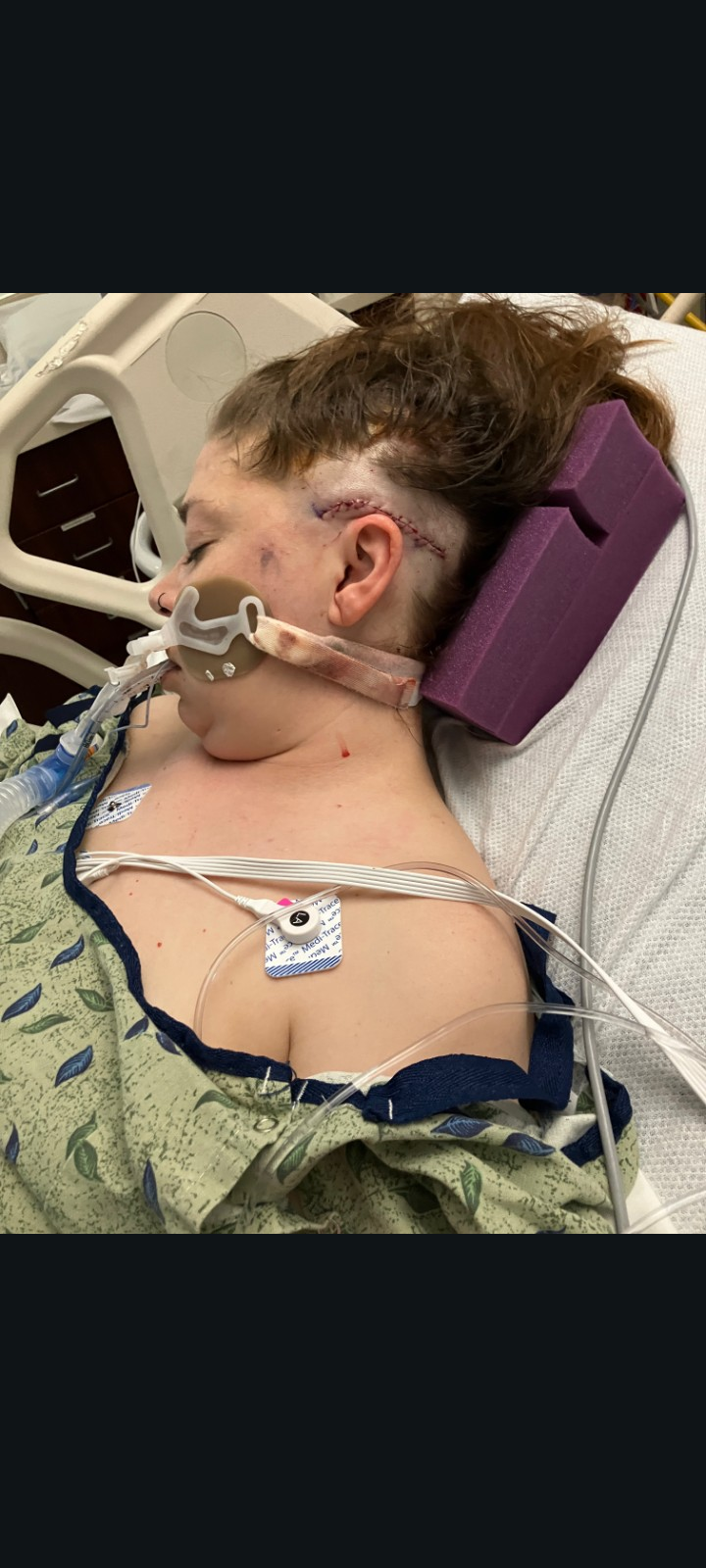 Emily’s journey to full recovery from her brain injury campaign photo, 5 of 6