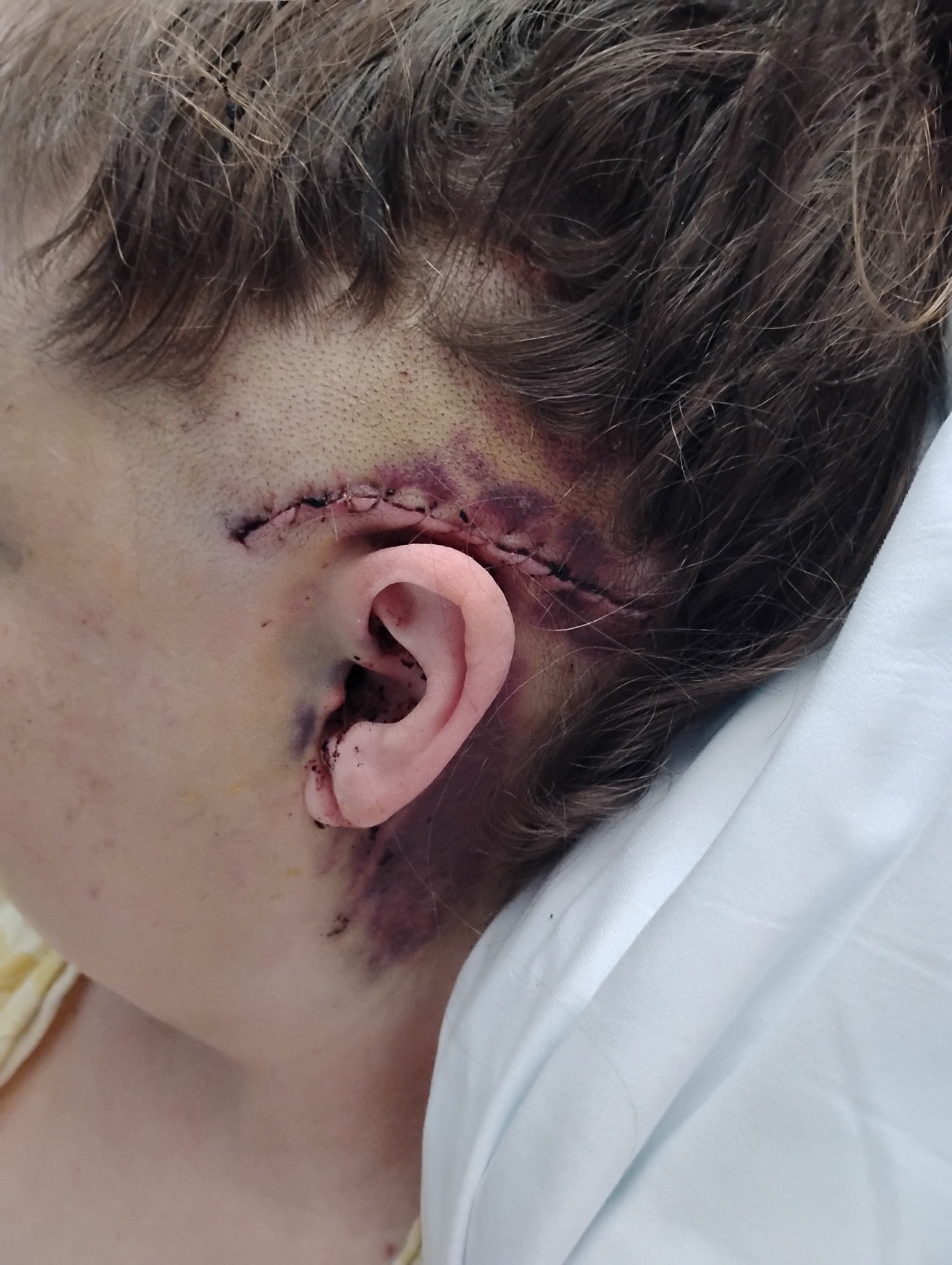 Emily’s journey to full recovery from her brain injury campaign photo, 2 of 6