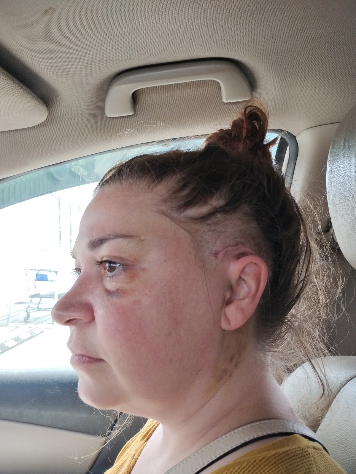 Emily’s journey to full recovery from her brain injury campaign photo, 4 of 6