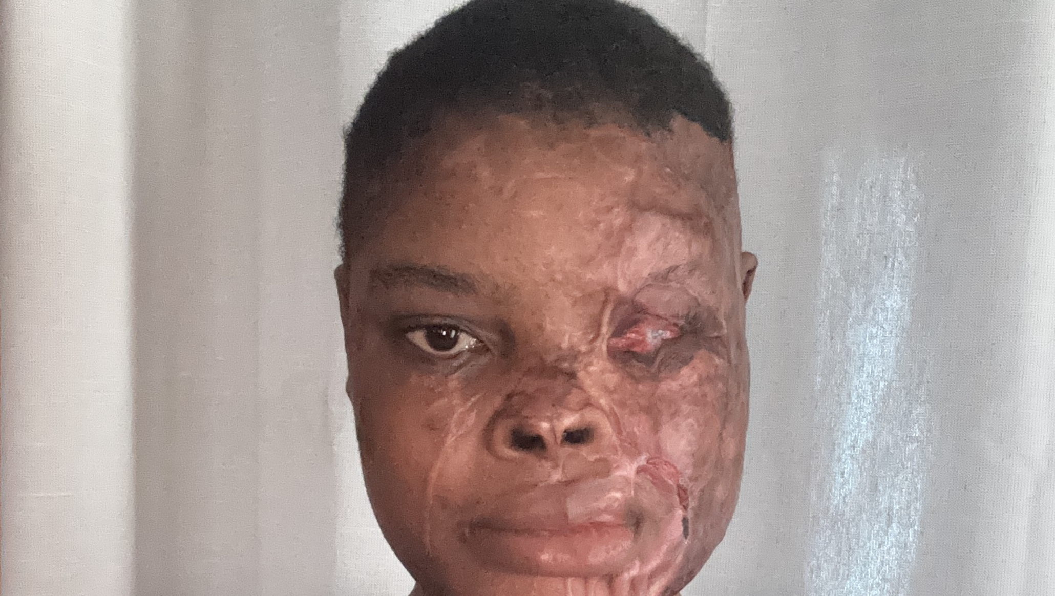 My Journey After an Acid Attack photo