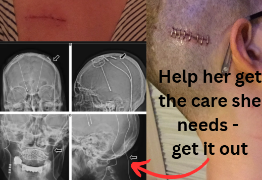 Rare & Painful Brain Implant Complication campaign photo, 5 of 7