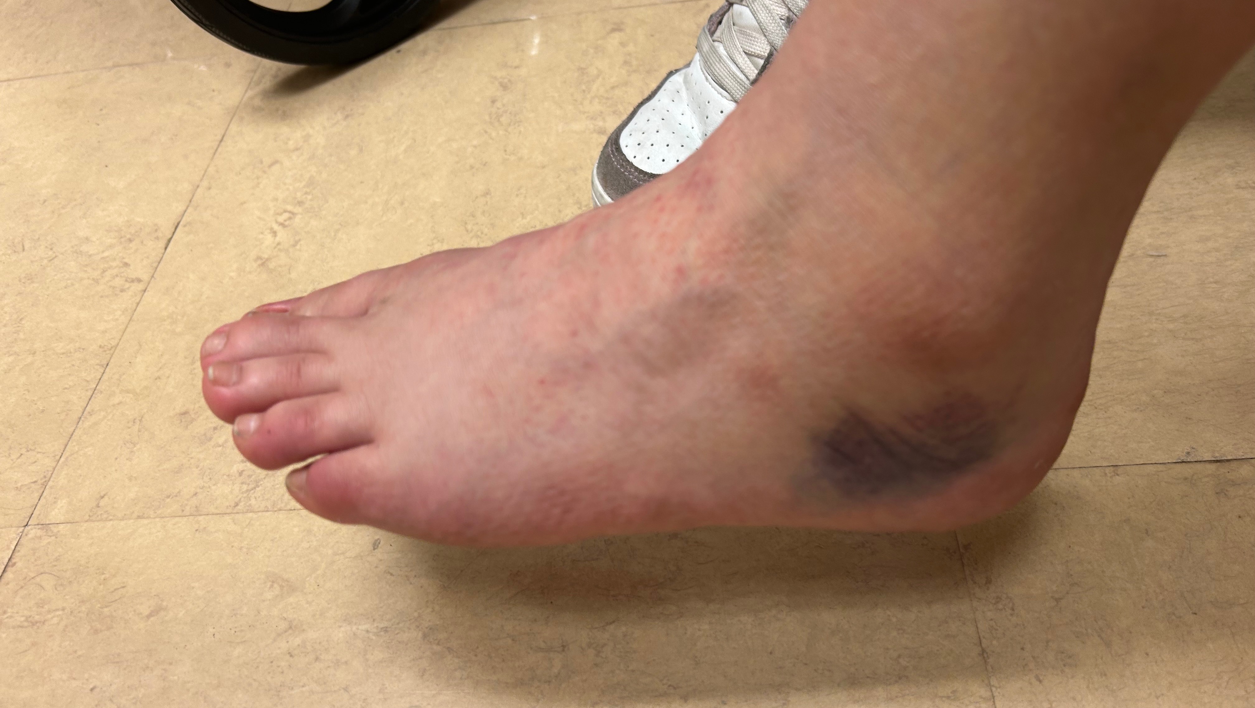 Aid for Jaimie’s Surgery and Bills photo