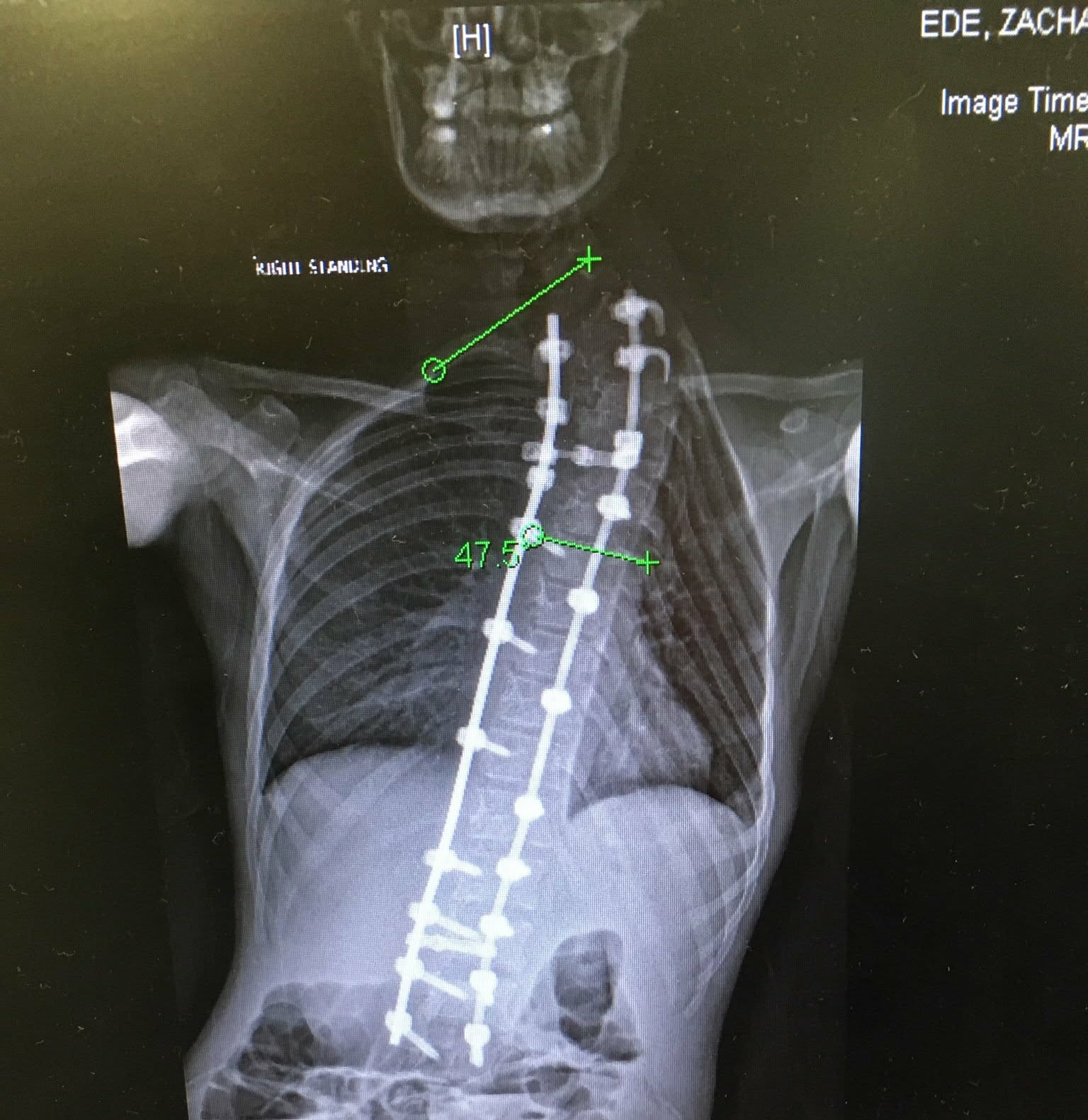 The Final Hurdle - Help Zac breathe, eat & finally heal campaign photo, 2 of 8