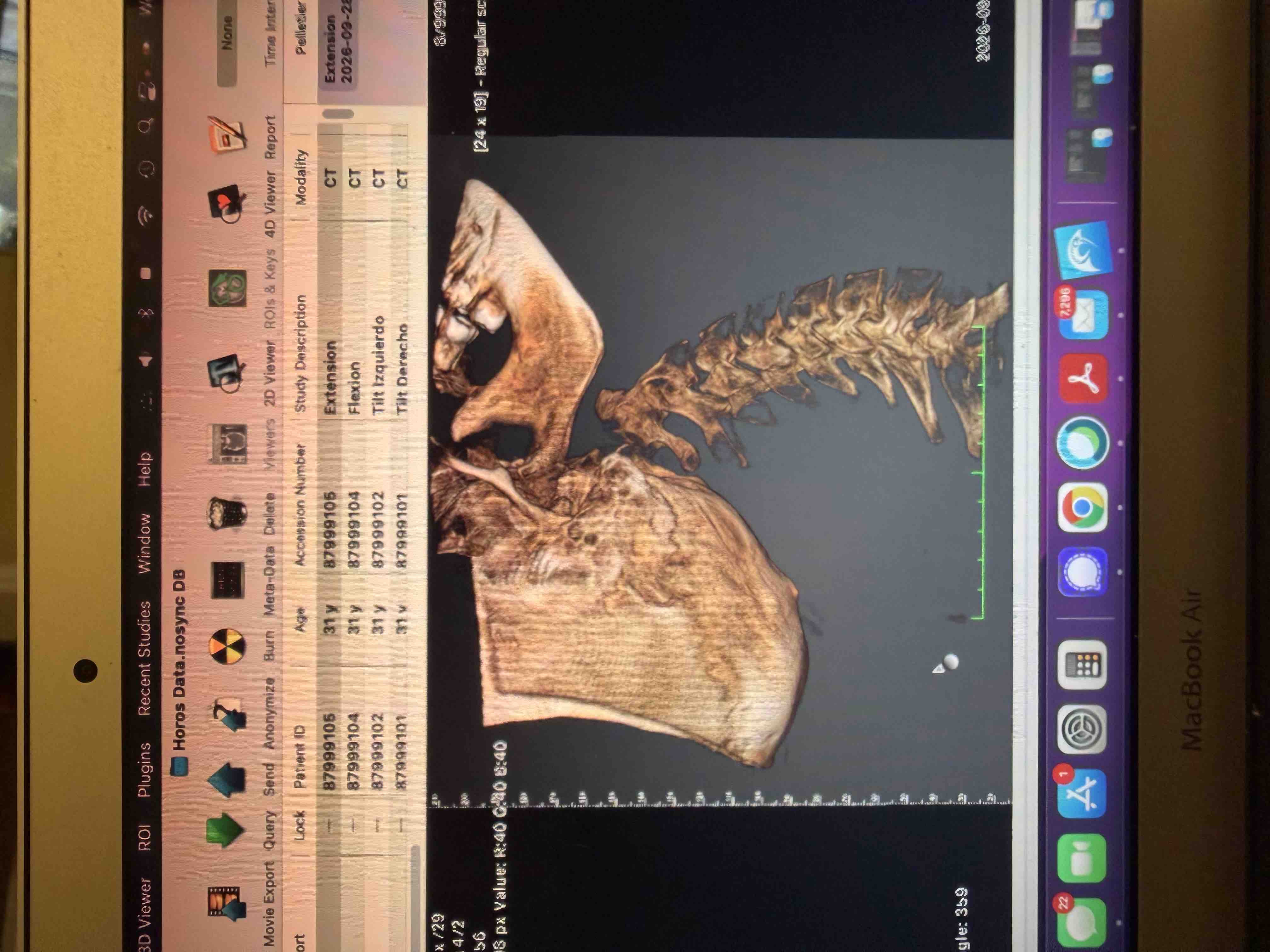 Help Bring Stability Back to Rei's Spine campaign photo, 10 of 13