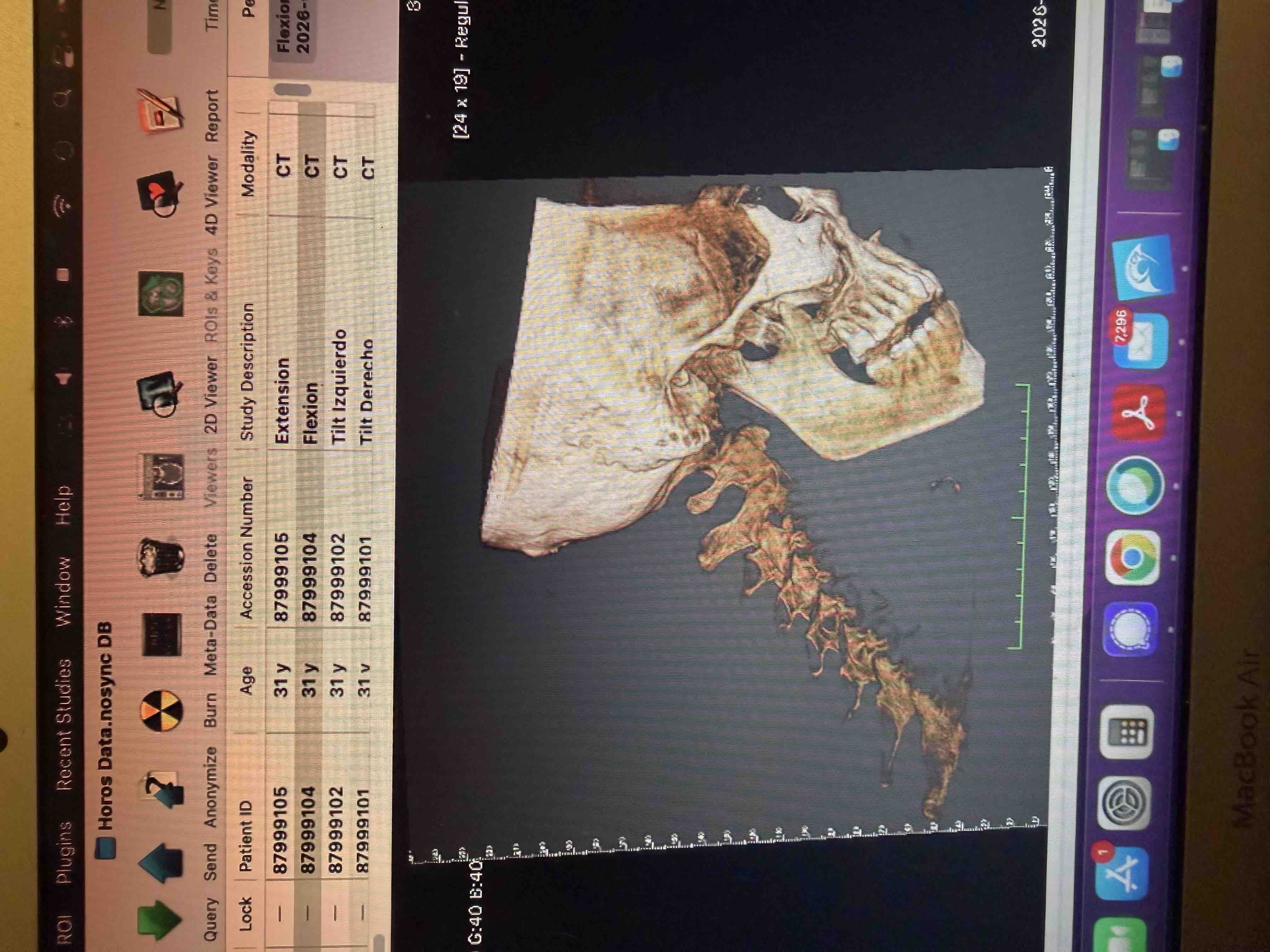 Help Bring Stability Back to Rei's Spine campaign photo, 11 of 13