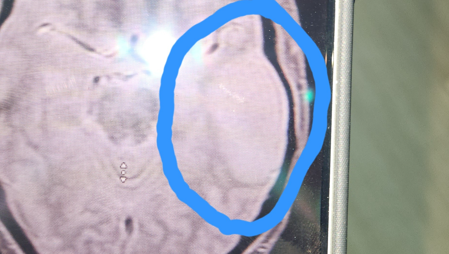 Support Amanda’s Brain Tumor Surgery and Recovery. photo