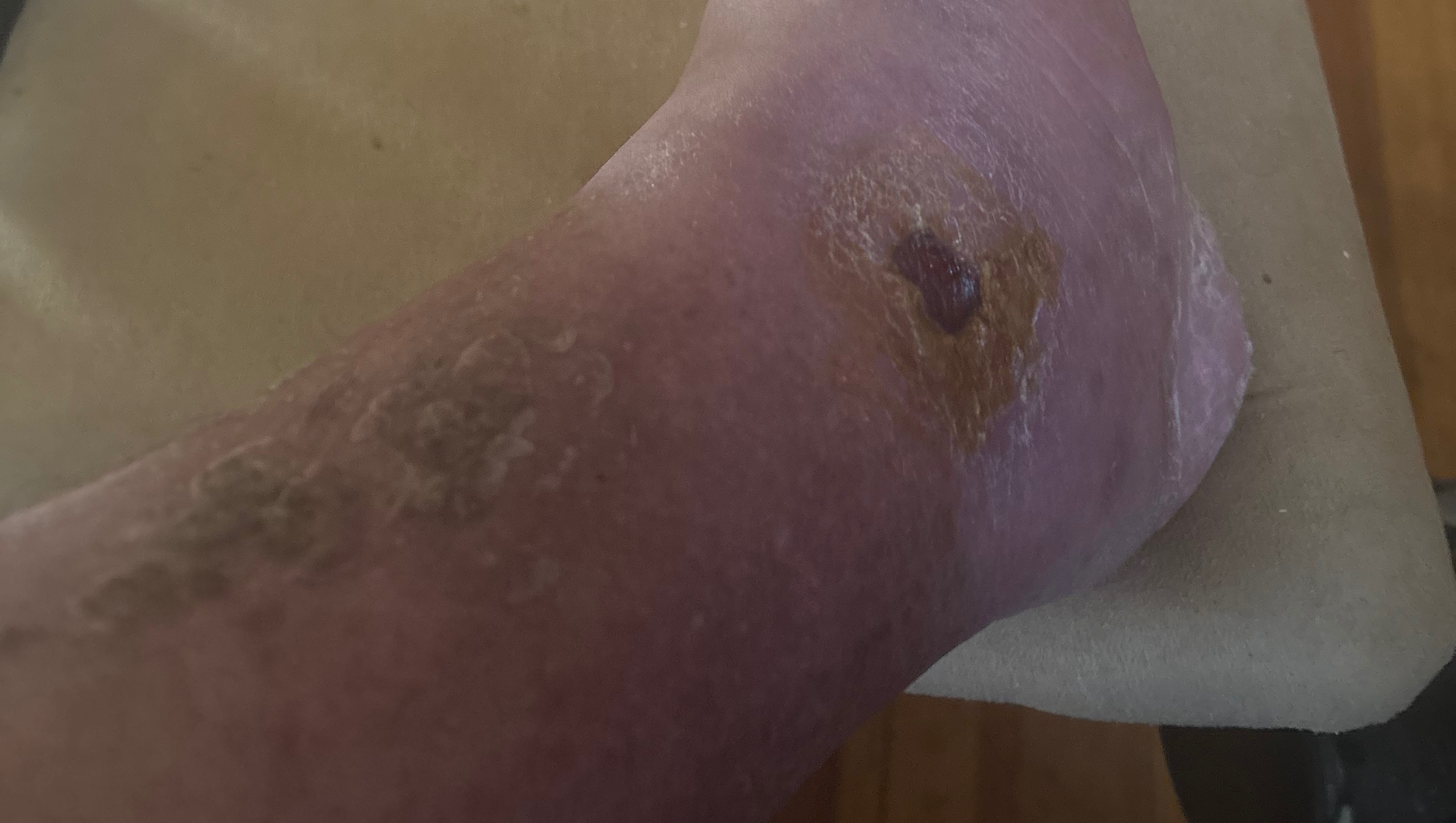 Help My Brother Save His Leg photo