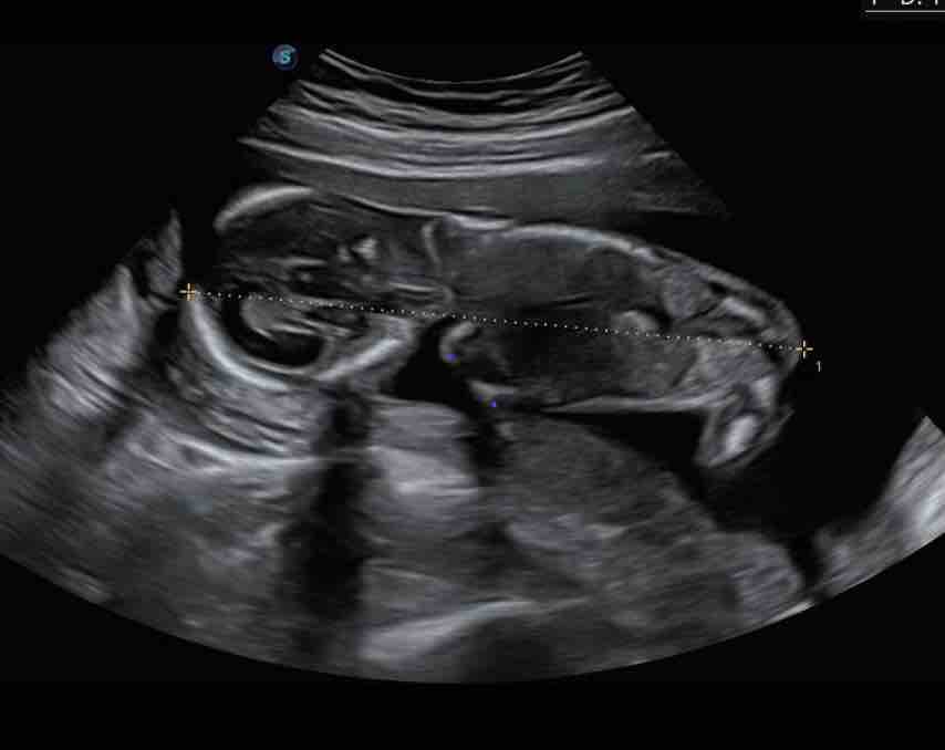 Support Baby Saelya’s Rare Journey campaign photo, 5 of 7