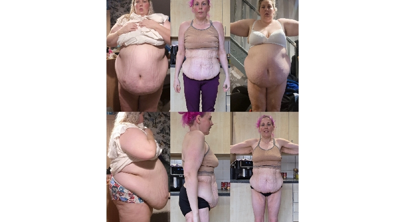 Skin Removal Support After Significant Weightloss photo