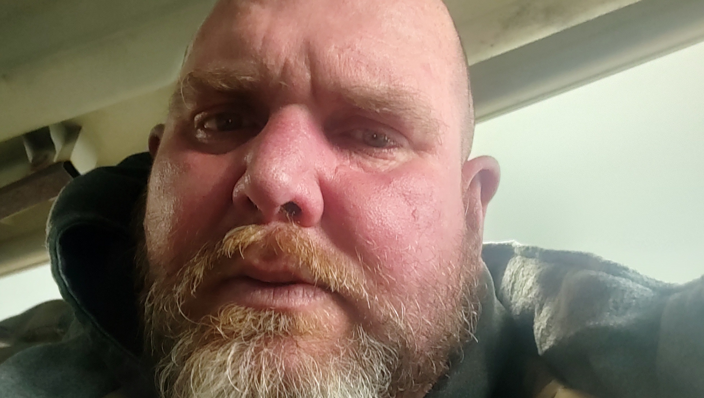 Fundraiser by Aaron Howe : Help Aaron Get Critical Medical Treatment