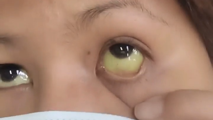 Help Cover Medical Costs for Urgent Jaundice Treatment  photo