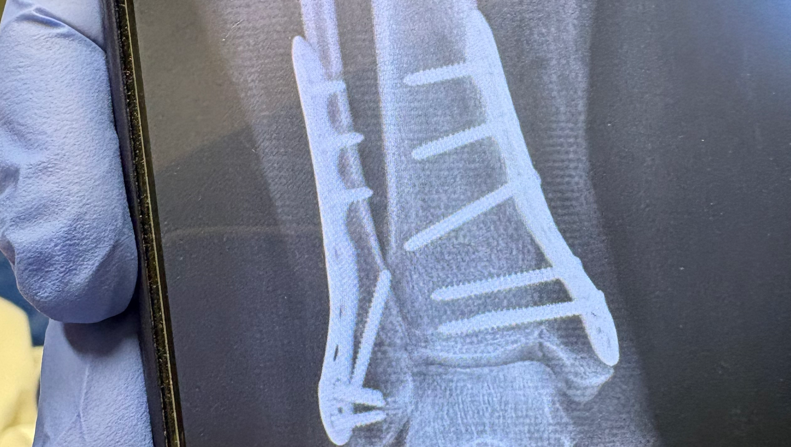 Help Monica Recover from Ankle Surgery photo