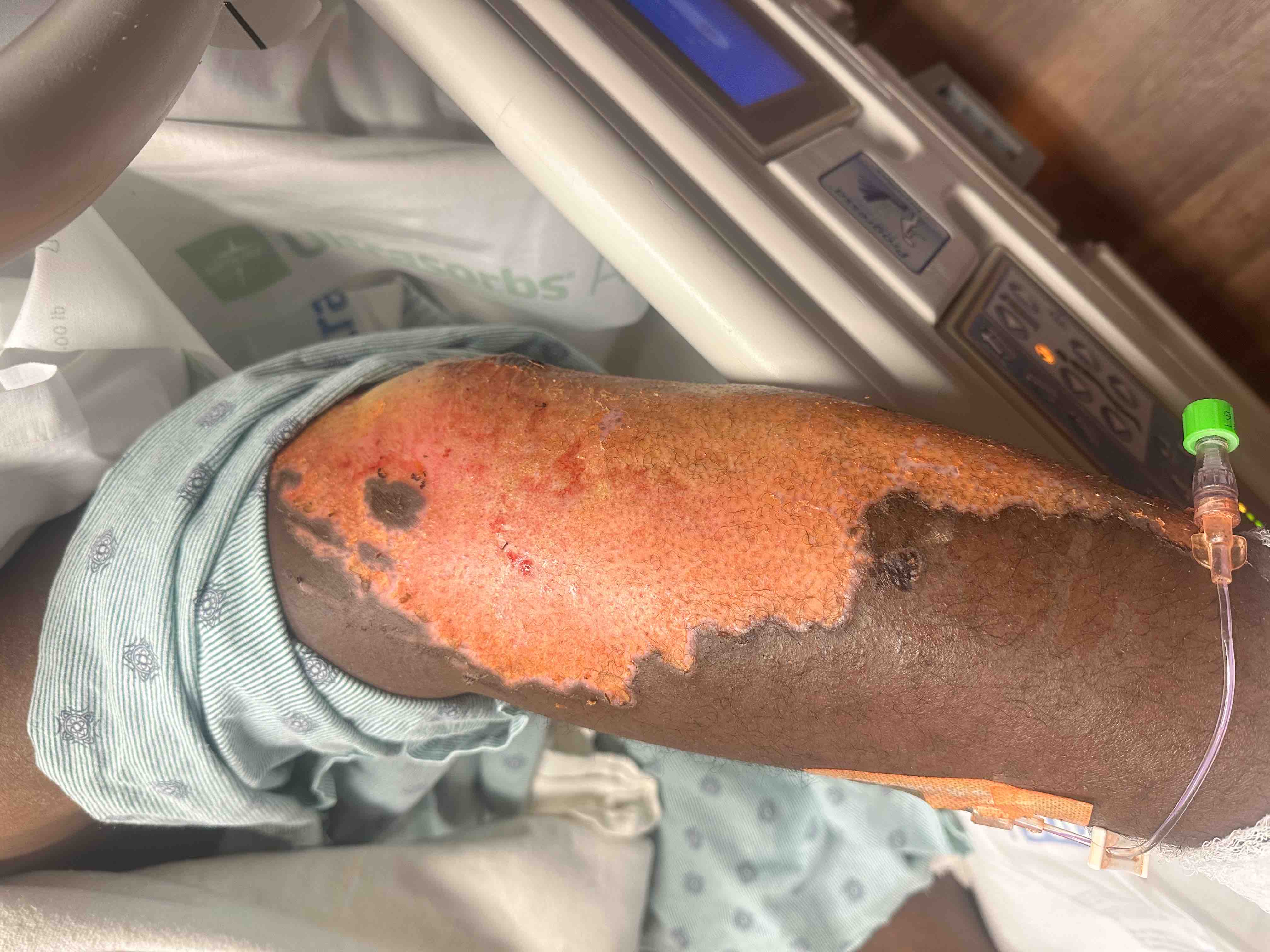 Help Burn Victim Edward Coleman Recover campaign photo, 4 of 8