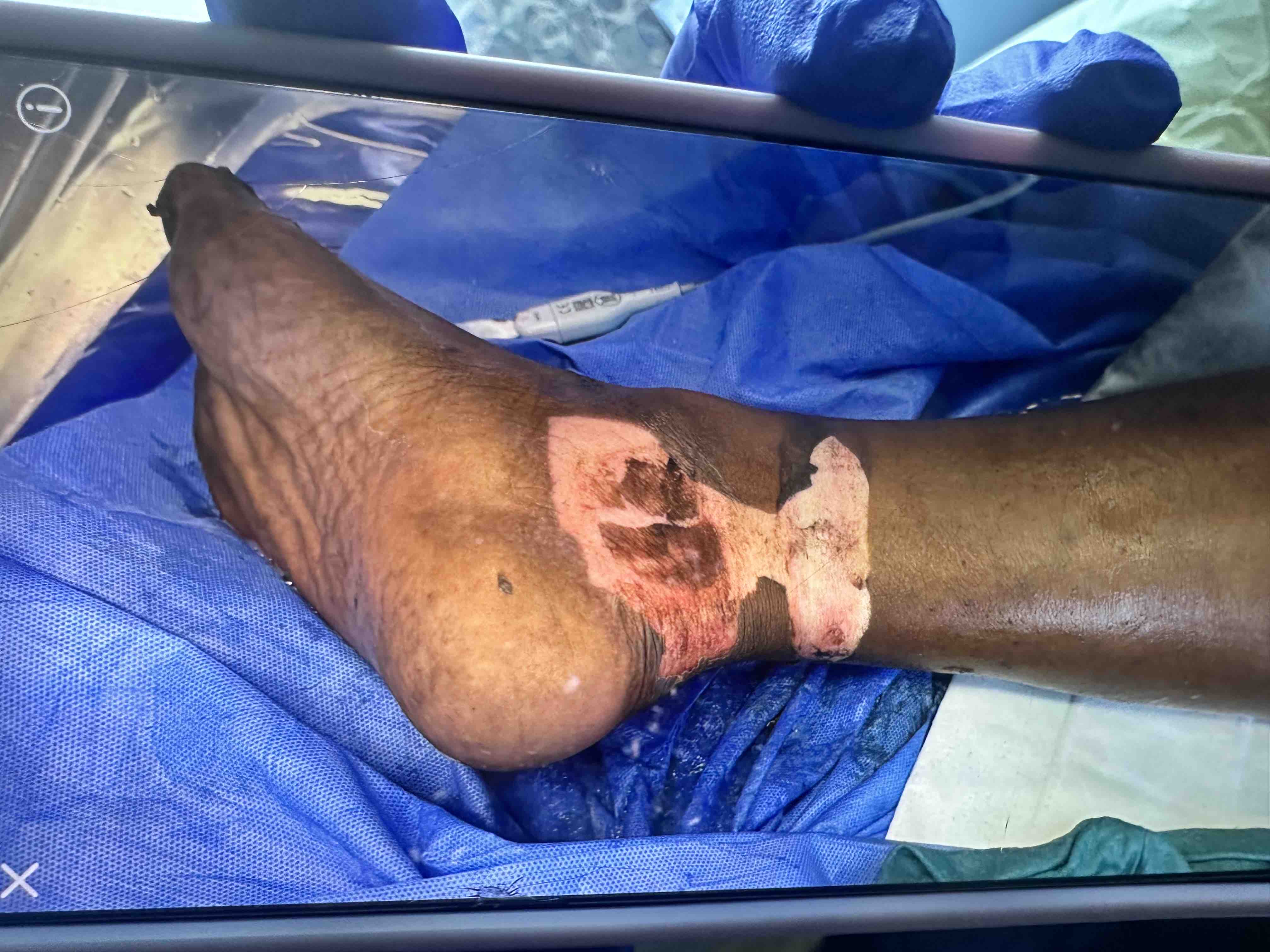 Help Burn Victim Edward Coleman Recover campaign photo, 5 of 8