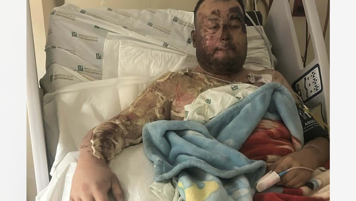 Help My Friend Recover from Burn Accident photo