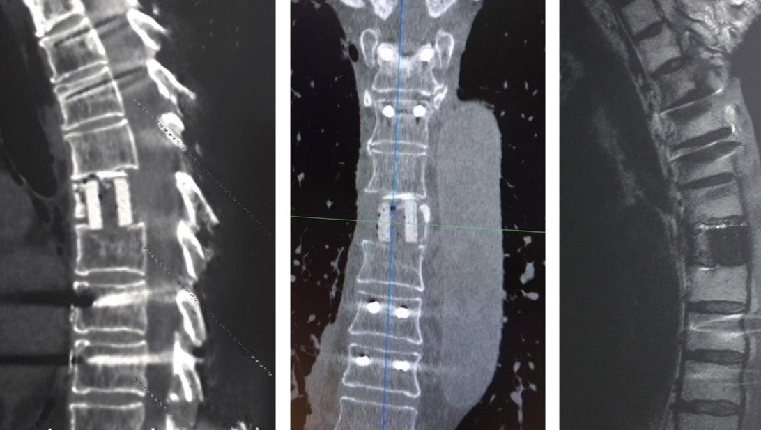 Help patients with spinal metastases photo