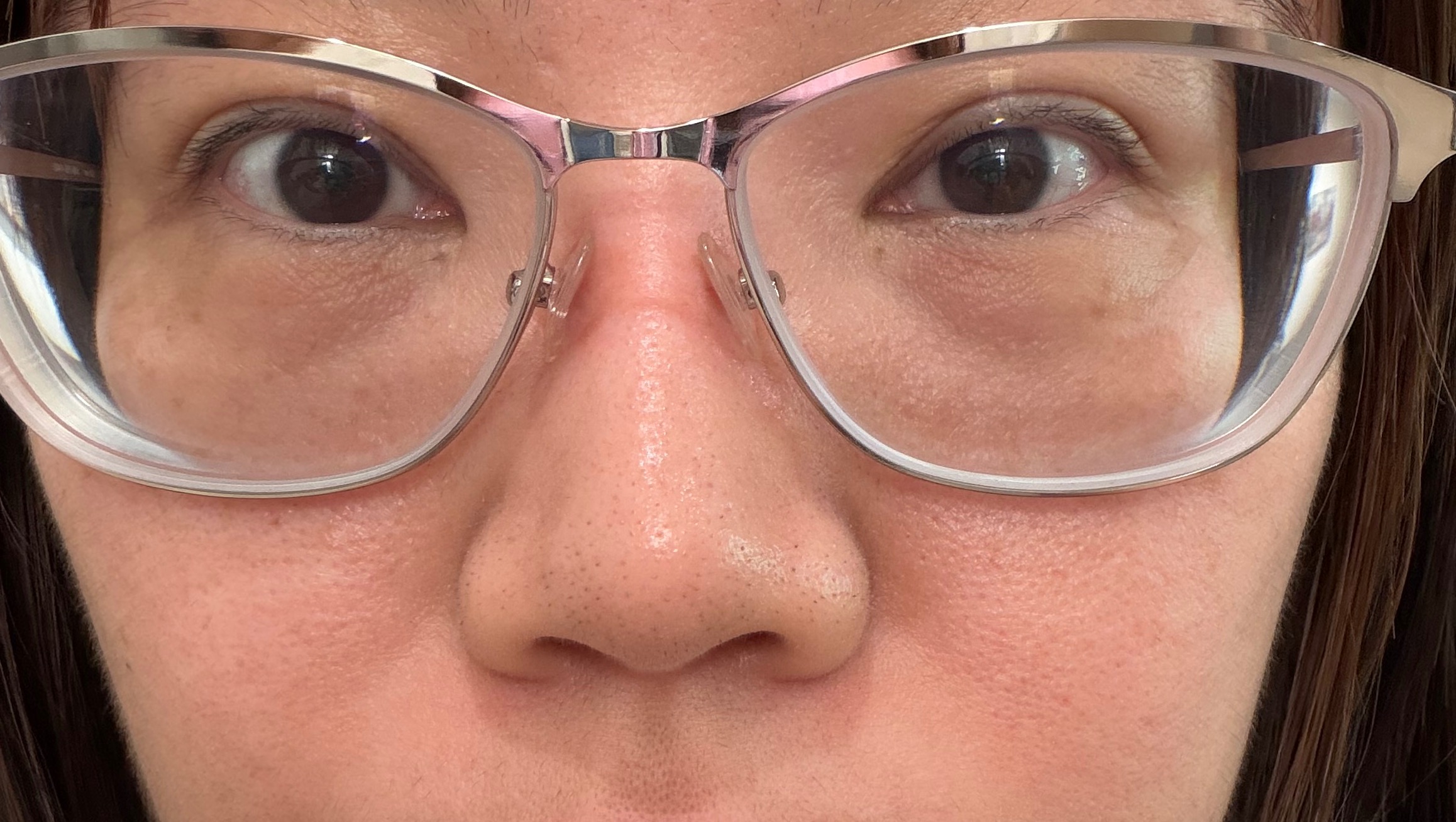 Help Lin Restore Vision with Cataract Surgery photo