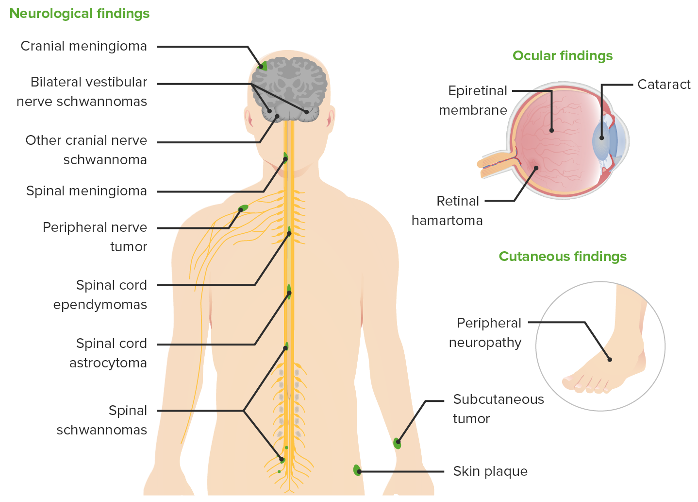 Help me recover my life: neurofibromatosis type 2& paralysis campaign photo, 4 of 7