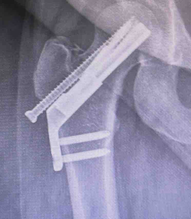 Help Chelsey pay rent after falling off stage, breaking hip campaign photo, 6 of 8