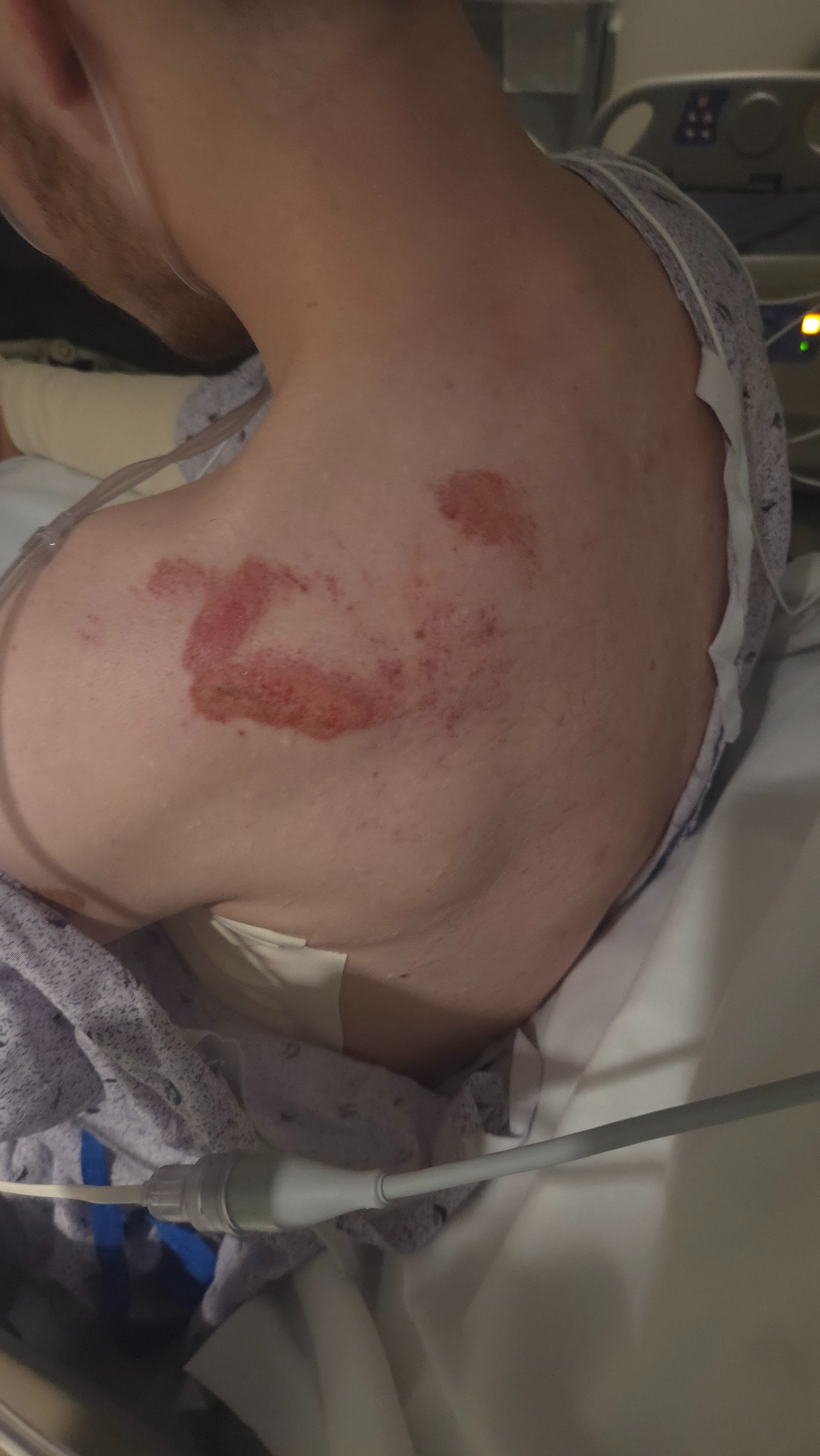 Fundraiser by Jacob Hardwick : Support Jacob’s Recovery After Accident