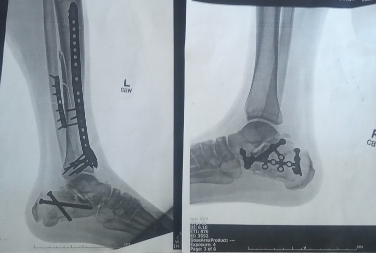 He served his country. Now he's fighting to walk again. campaign photo, 2 of 8