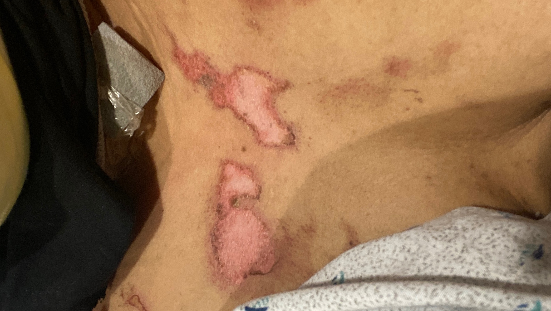 Help Me Heal After a Fire Accident photo