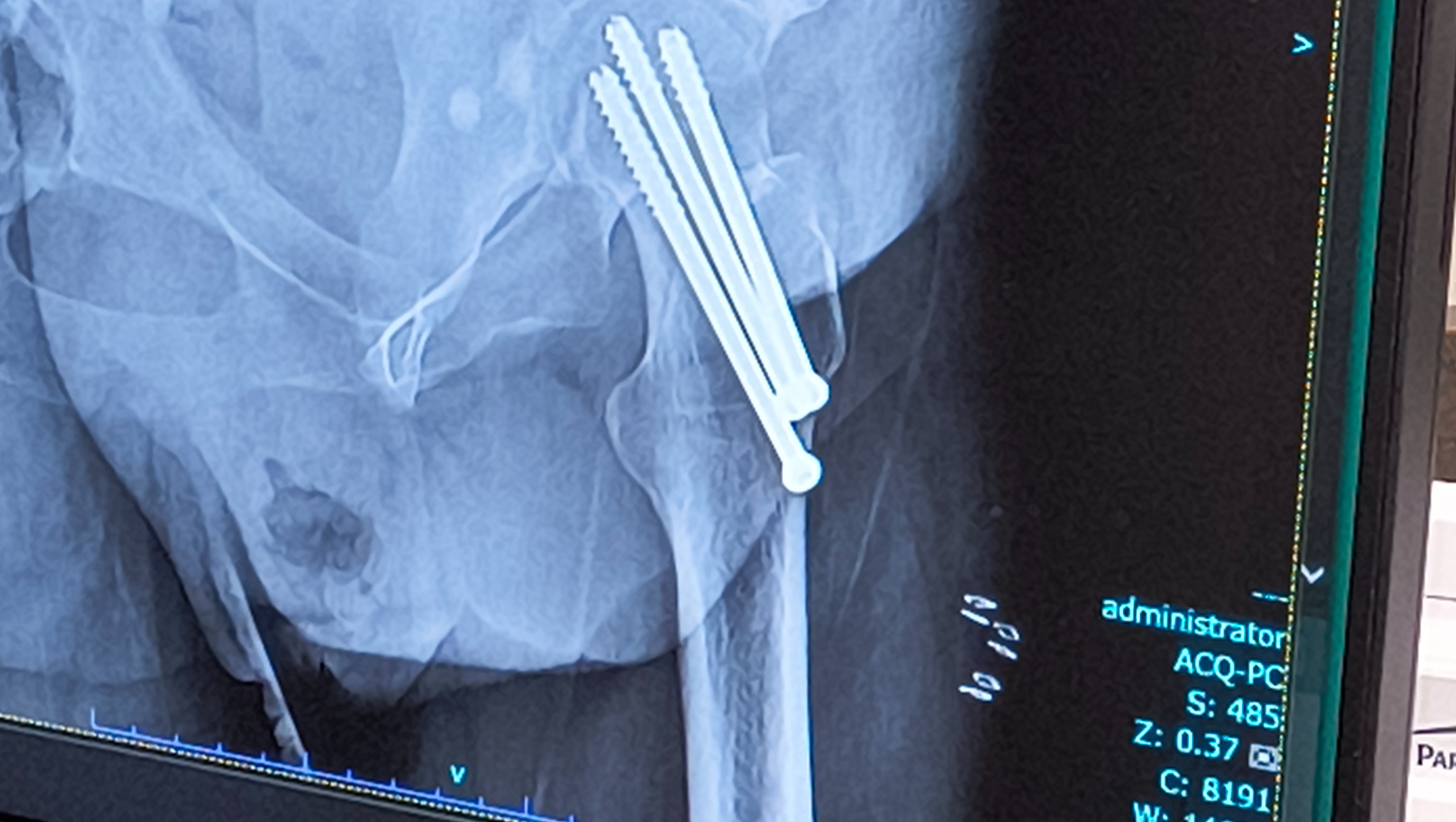 Help Summer Recover After Hip Injury photo