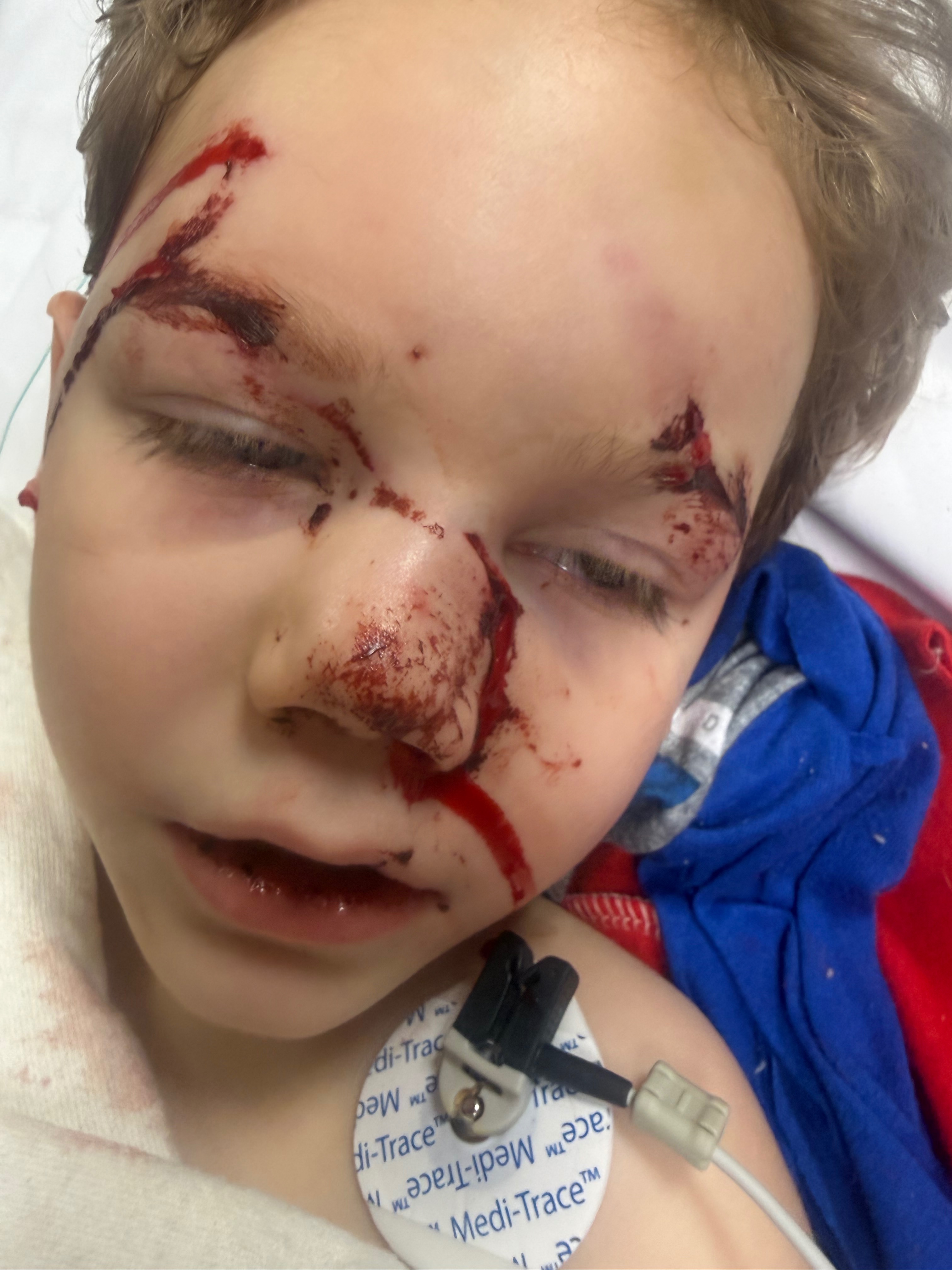 Help My Son Heal After Pit Bull Attack campaign photo, 6 of 7
