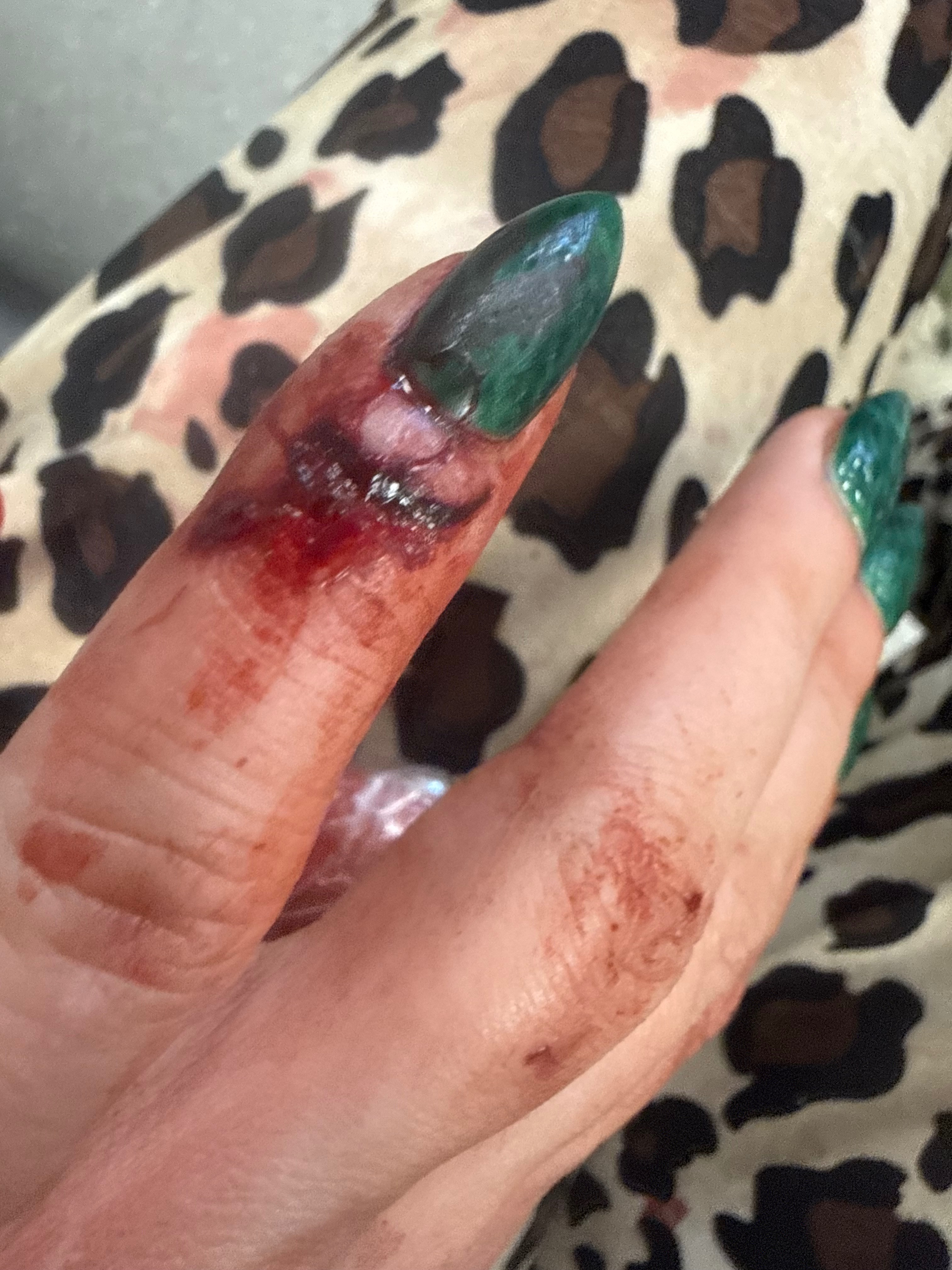 Help My Son Heal After Pit Bull Attack campaign photo, 4 of 7