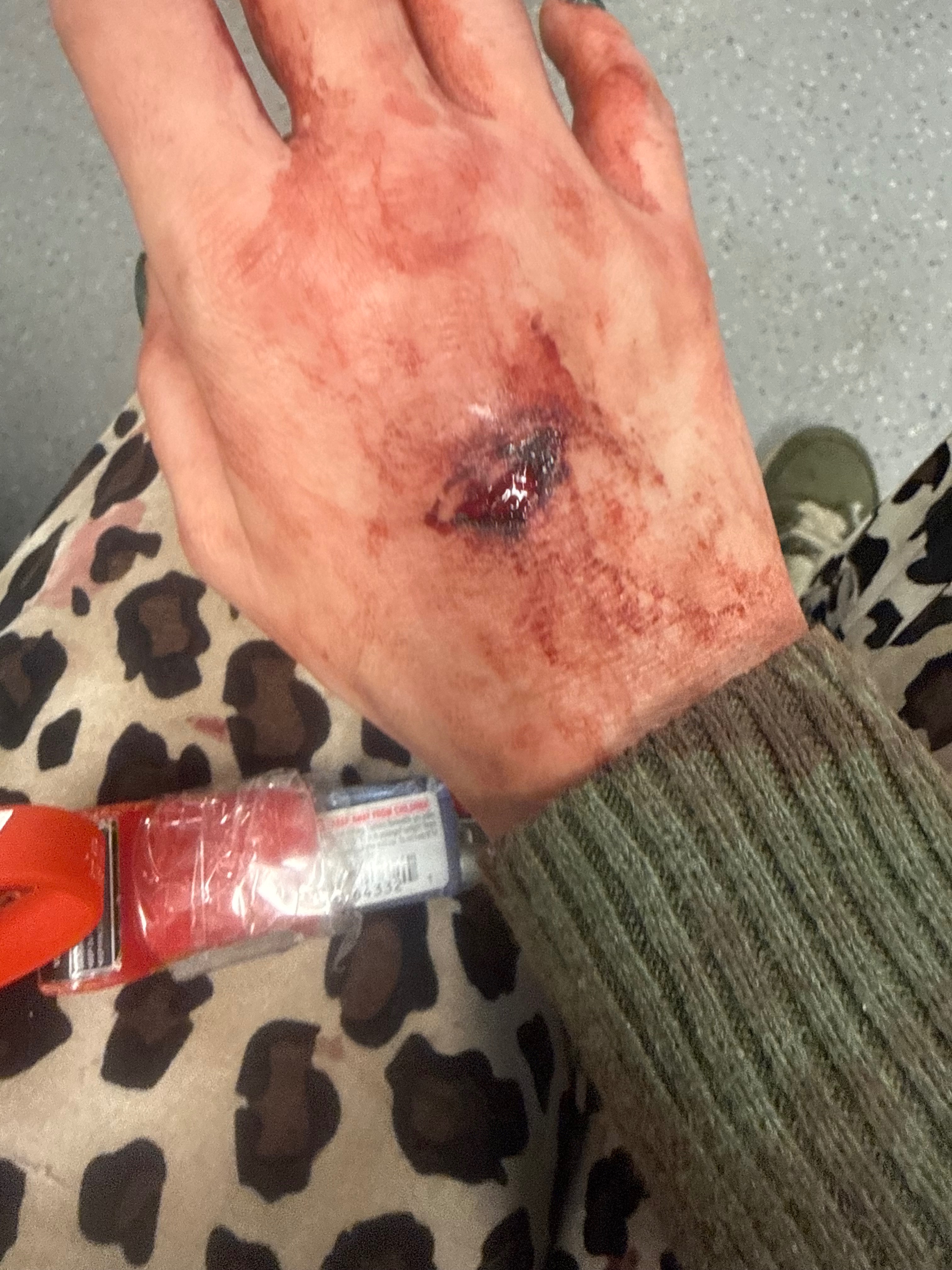 Help My Son Heal After Pit Bull Attack campaign photo, 5 of 7