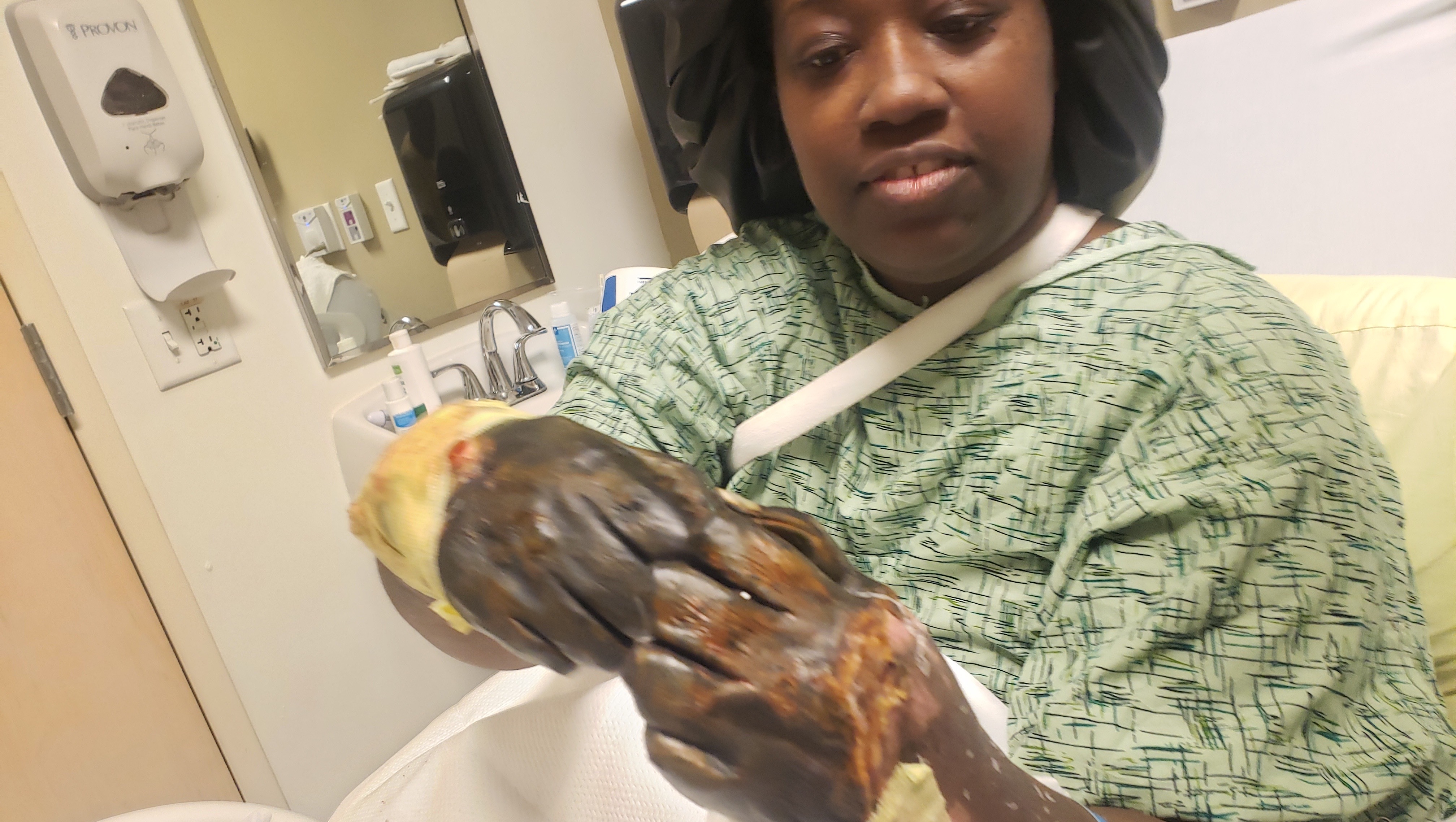 Help Nicole Get Prosthetic Hands photo