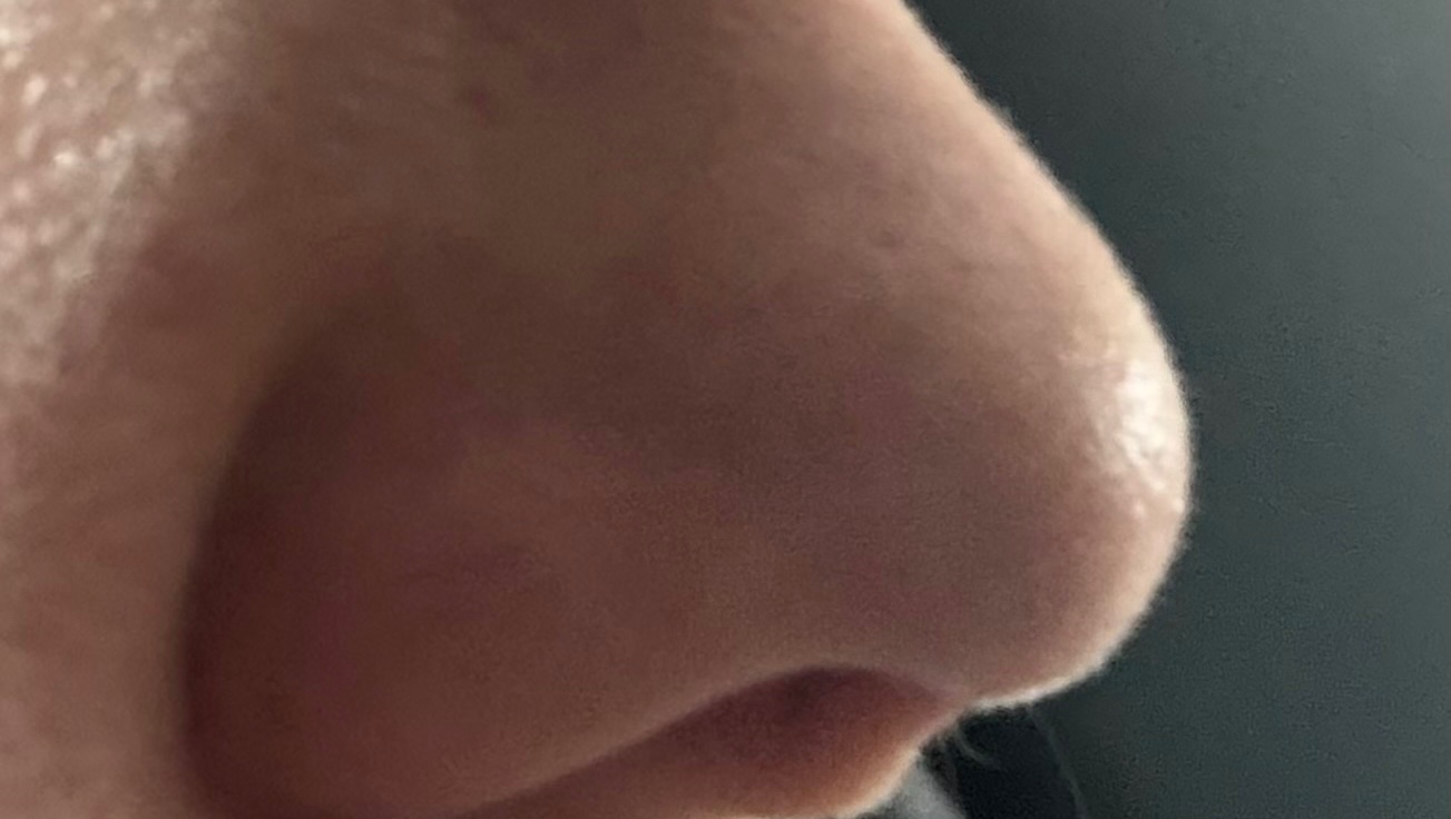 Support Julianna’s Nose Surgery photo