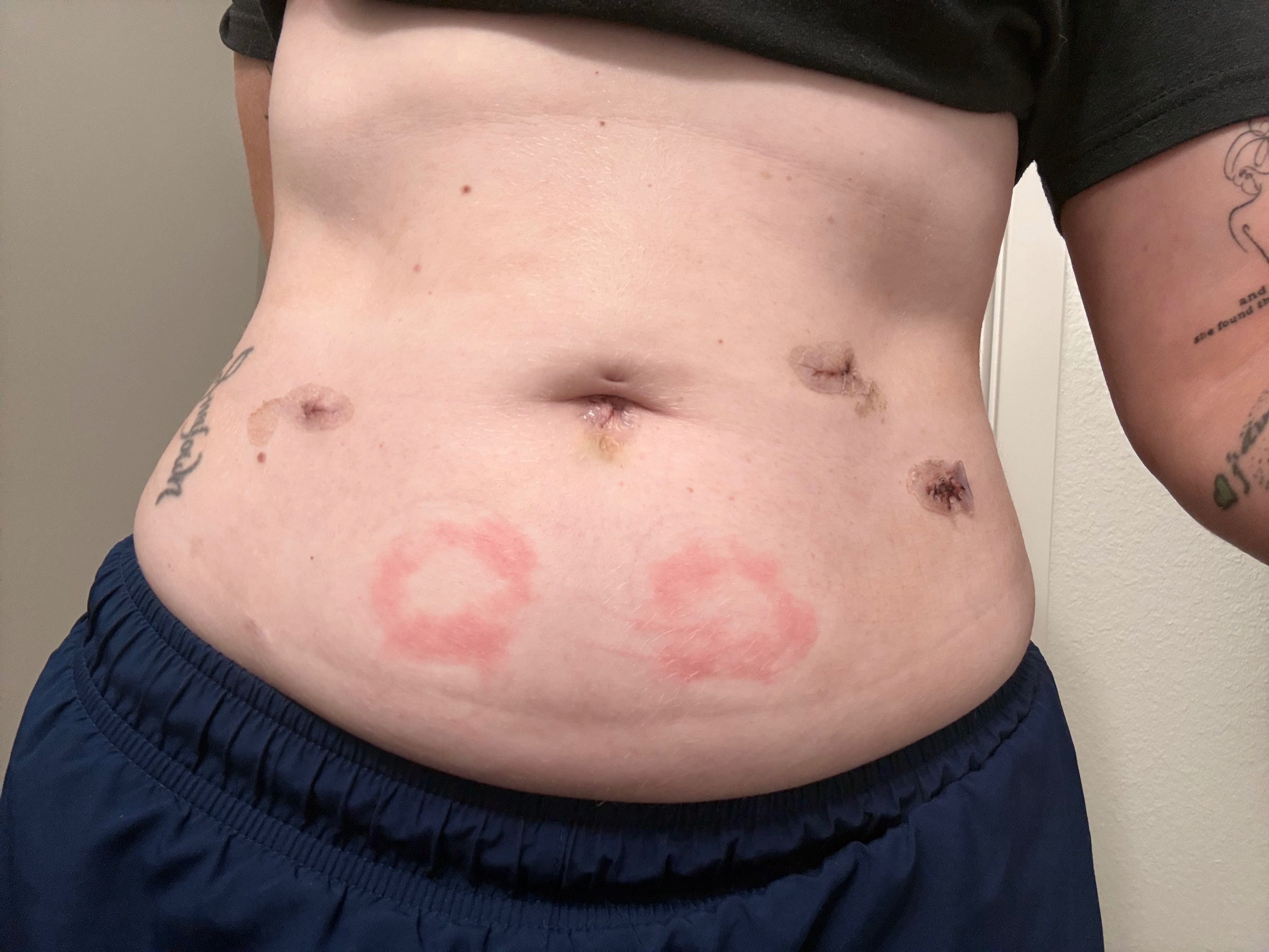 IVF Wasn’t Enough: My Battle with Endo, Adeno, and Lupus campaign photo, 6 of 8
