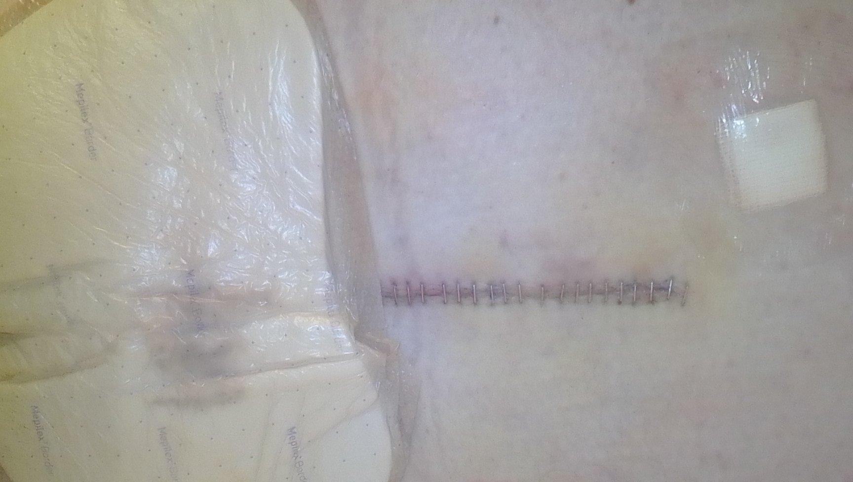 Support My Recovery After Major Back Surgery photo