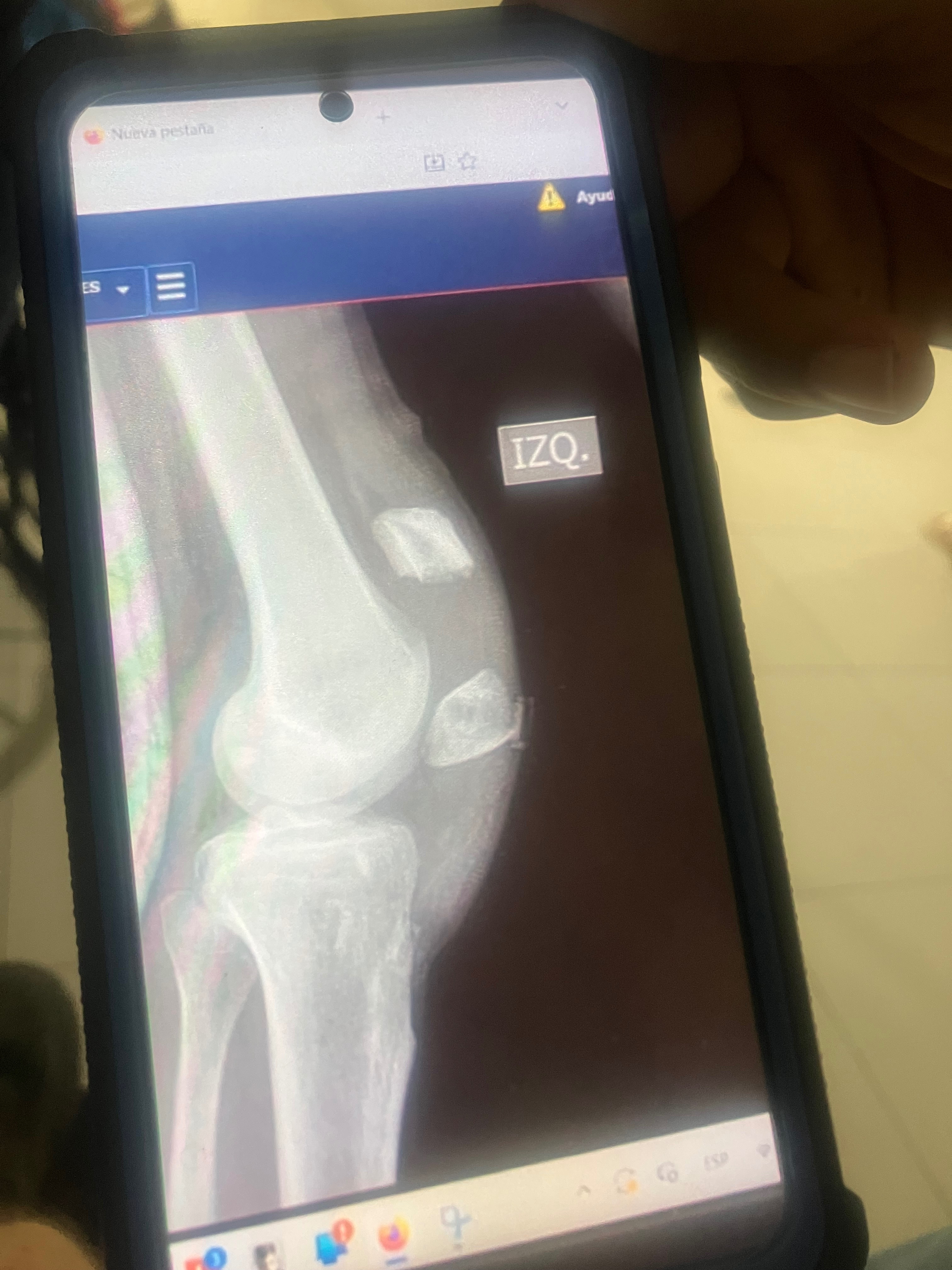 Fractured kneecap recovery… campaign photo, 7 of 8