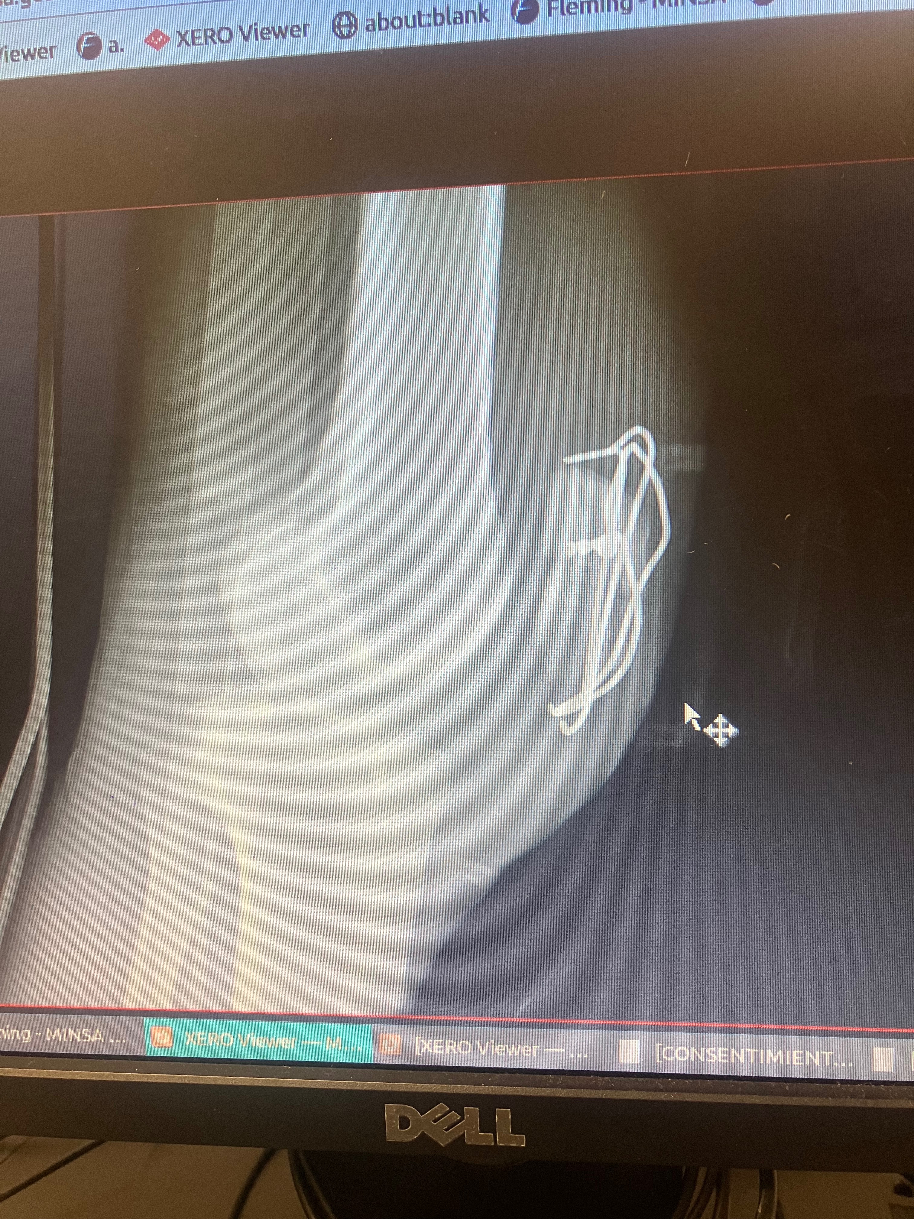Fractured kneecap recovery… campaign photo, 4 of 8