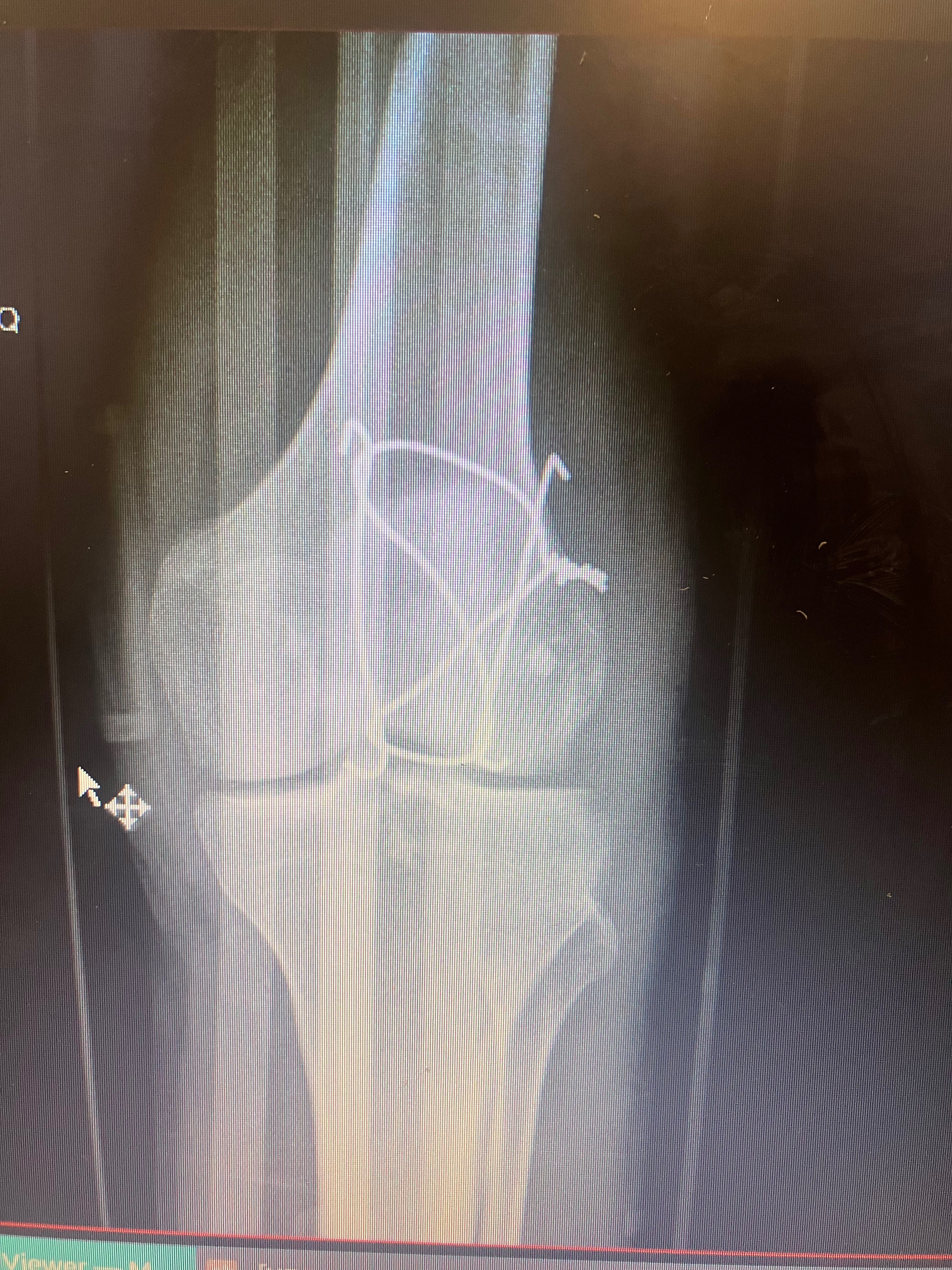 Fractured kneecap recovery… campaign photo, 5 of 8