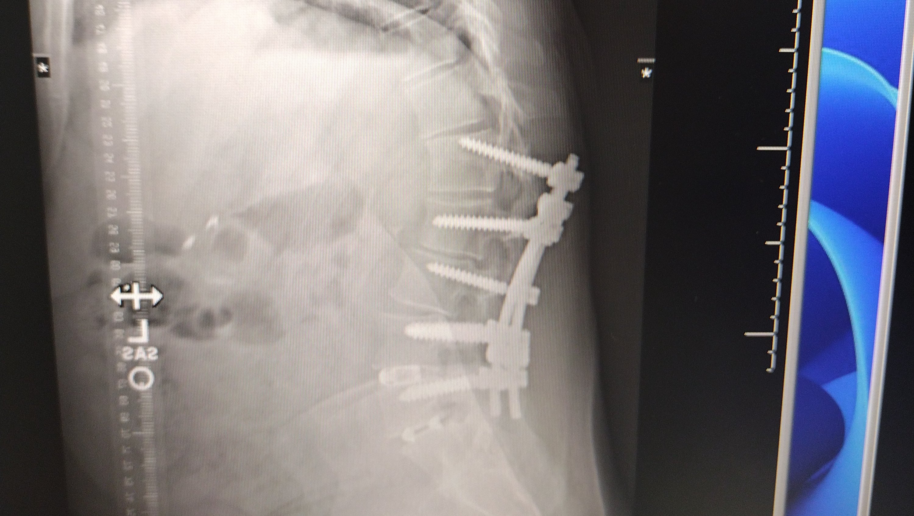 Support Brandon’s Recovery After Spinal Surgery photo