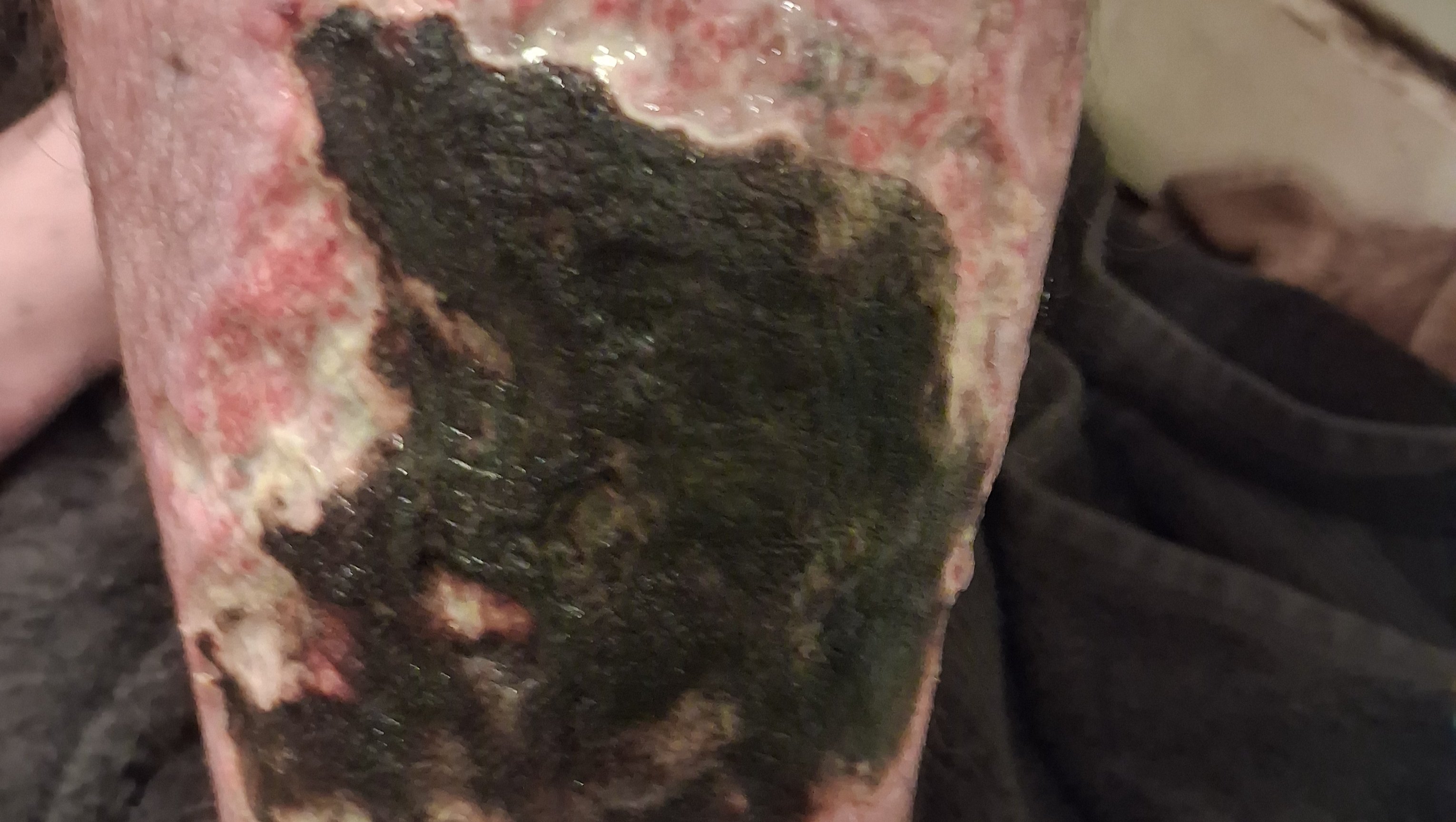 Help Scott’s Family Recover After Spider Bite photo